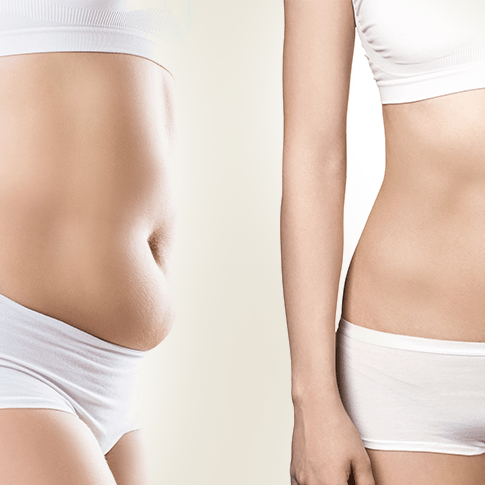 tummy fat removal surgery
