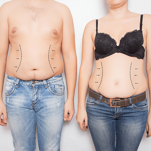 stomach fat removal surgery