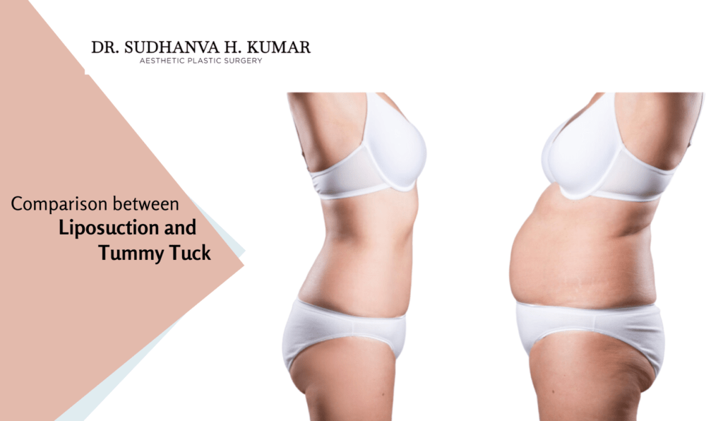 Tummy Tuck vs. Liposuction