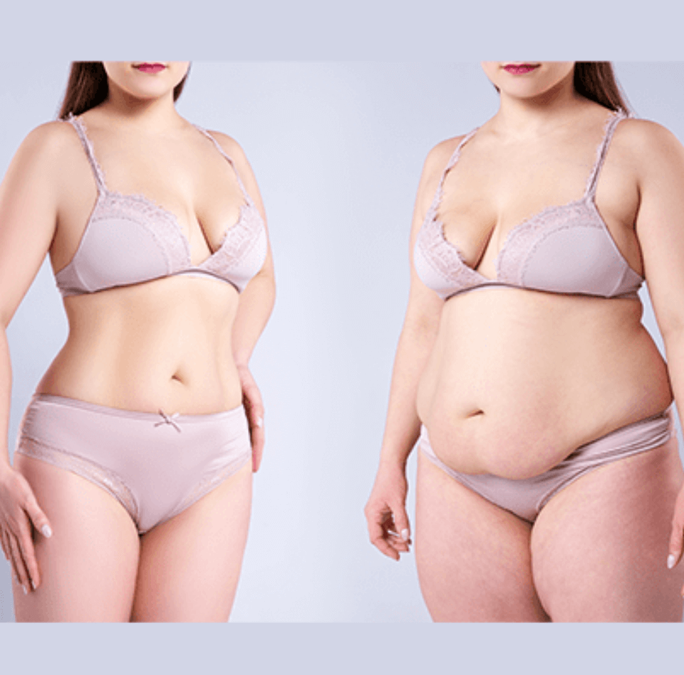  What is the Difference Between a Tummy Tuck and Liposuction?