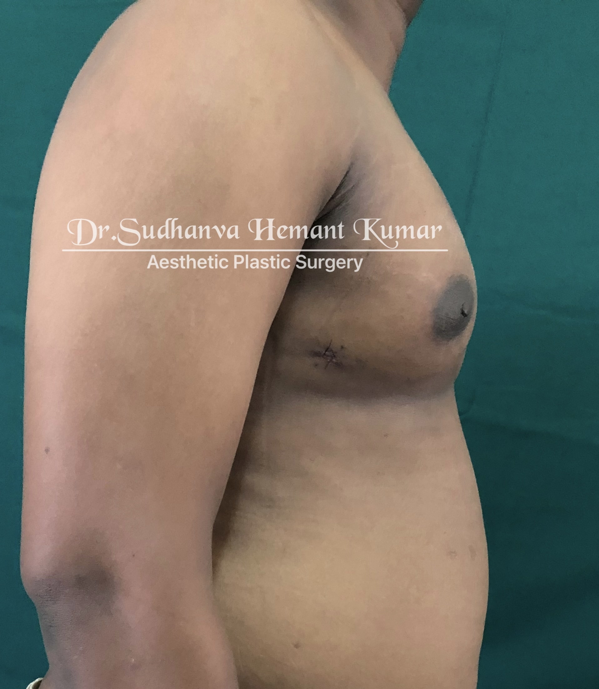 male chest reduction in mumbai