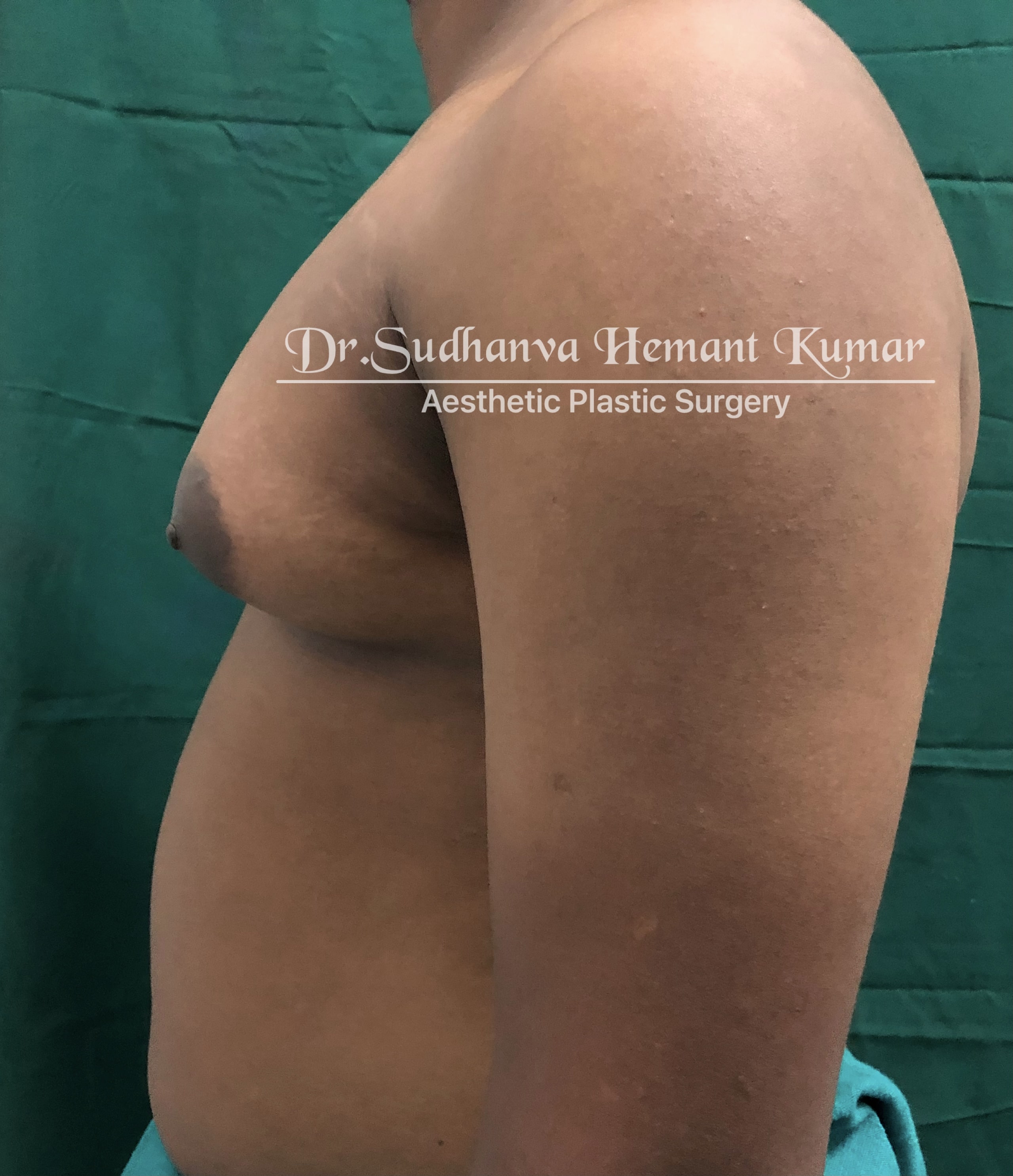 male breast reduction surgery in india