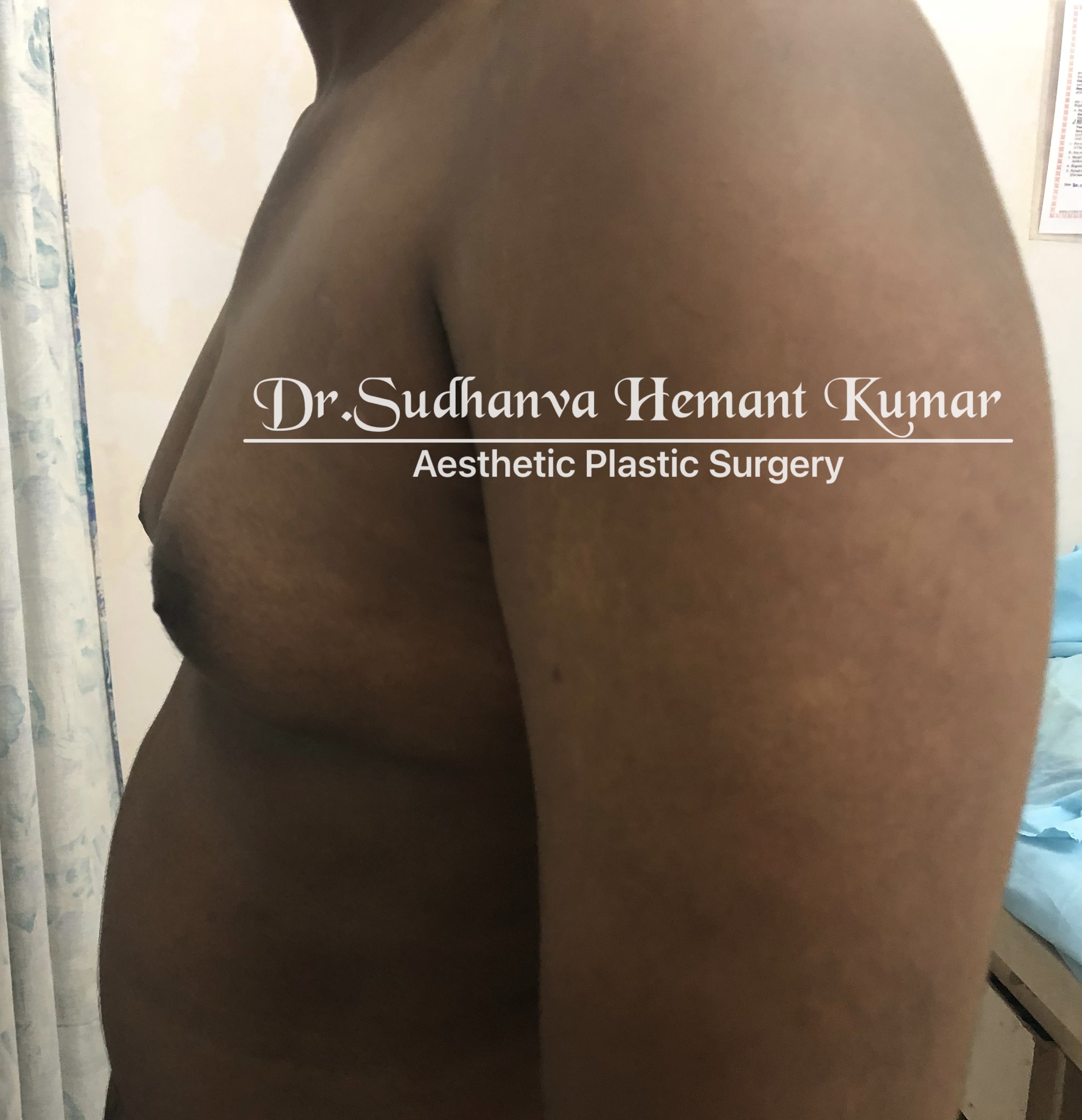 male boobs reduction in mumbai
