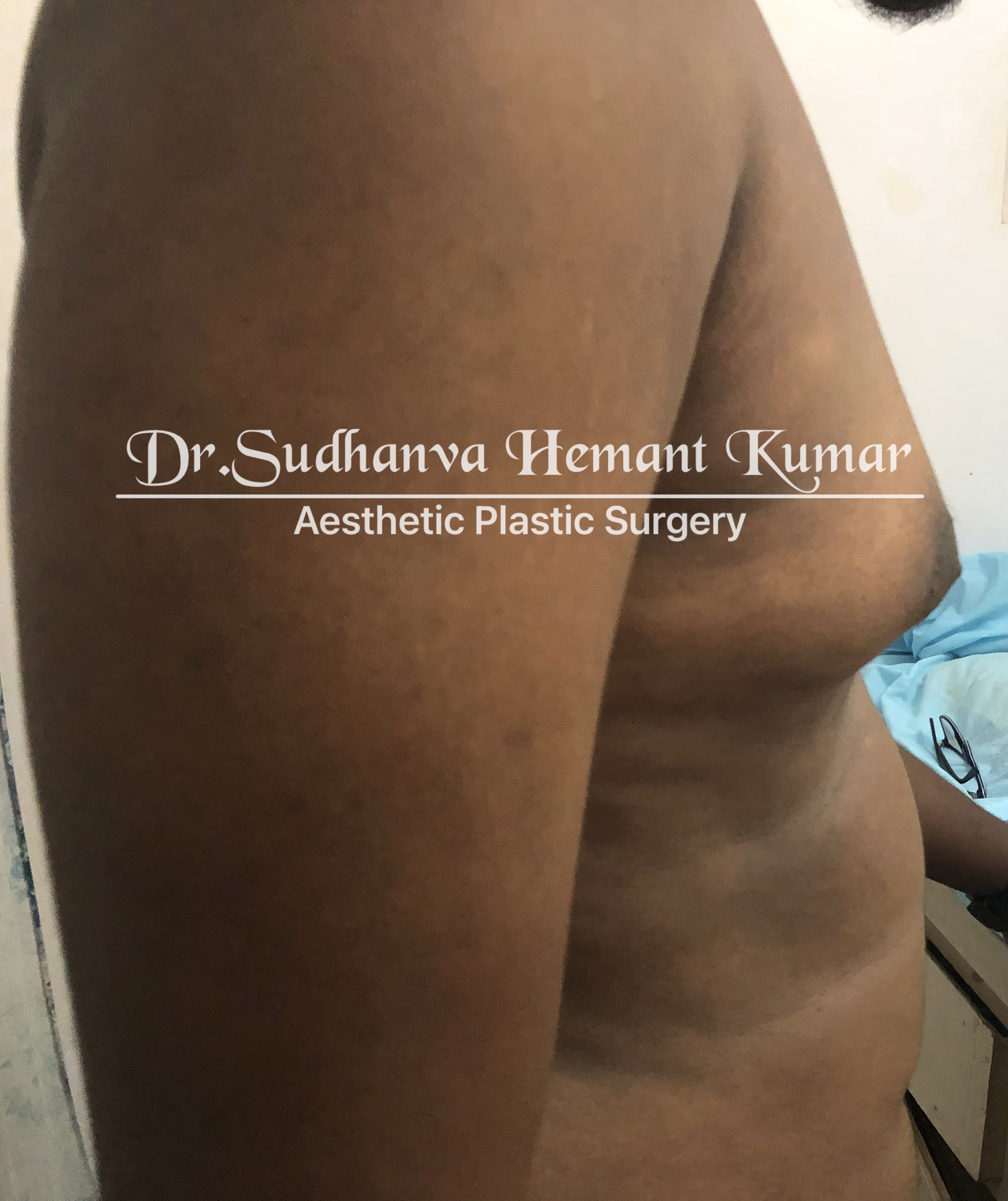 top male boobs reduction in mumbai