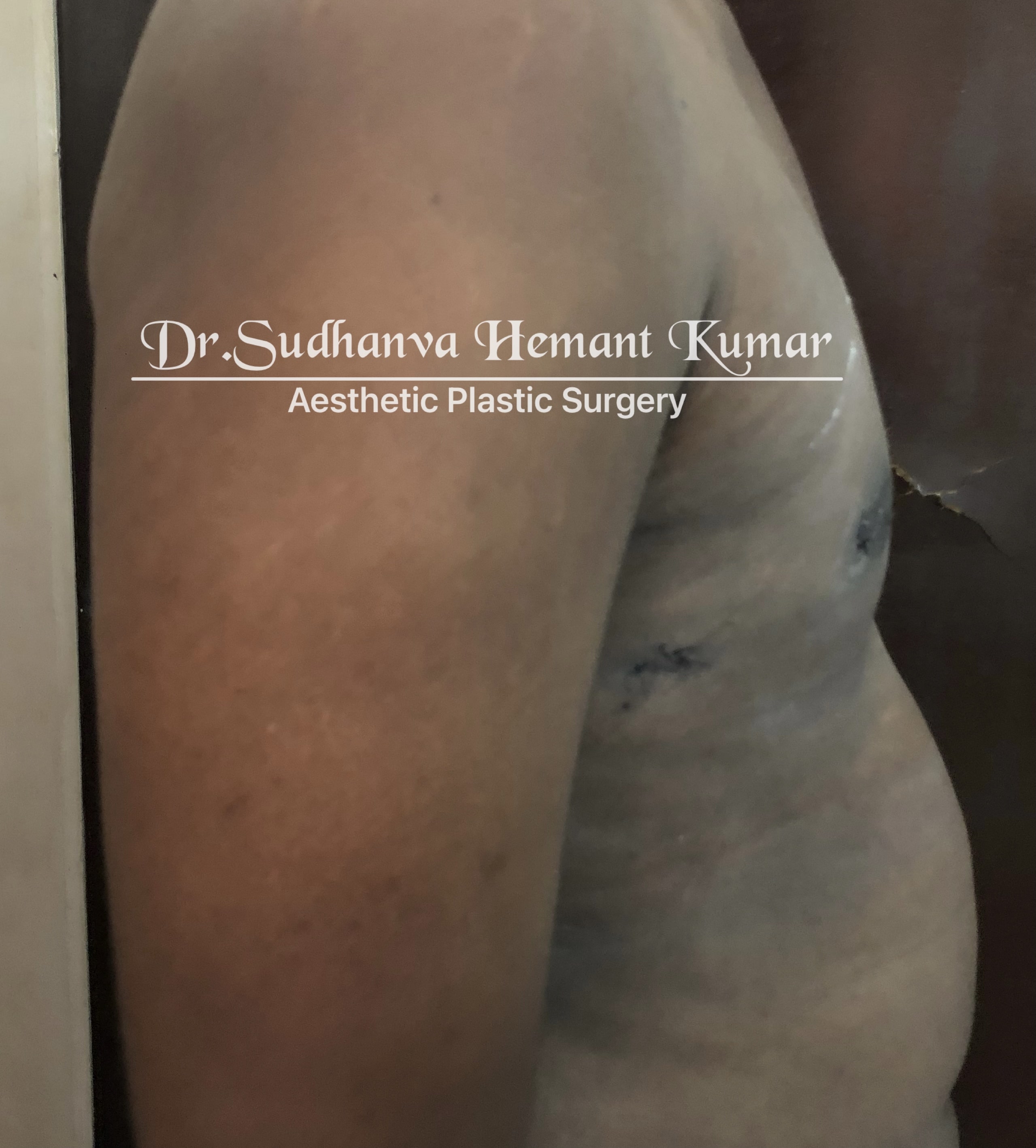 male boobs reduction in mumbai dr Sudhanva