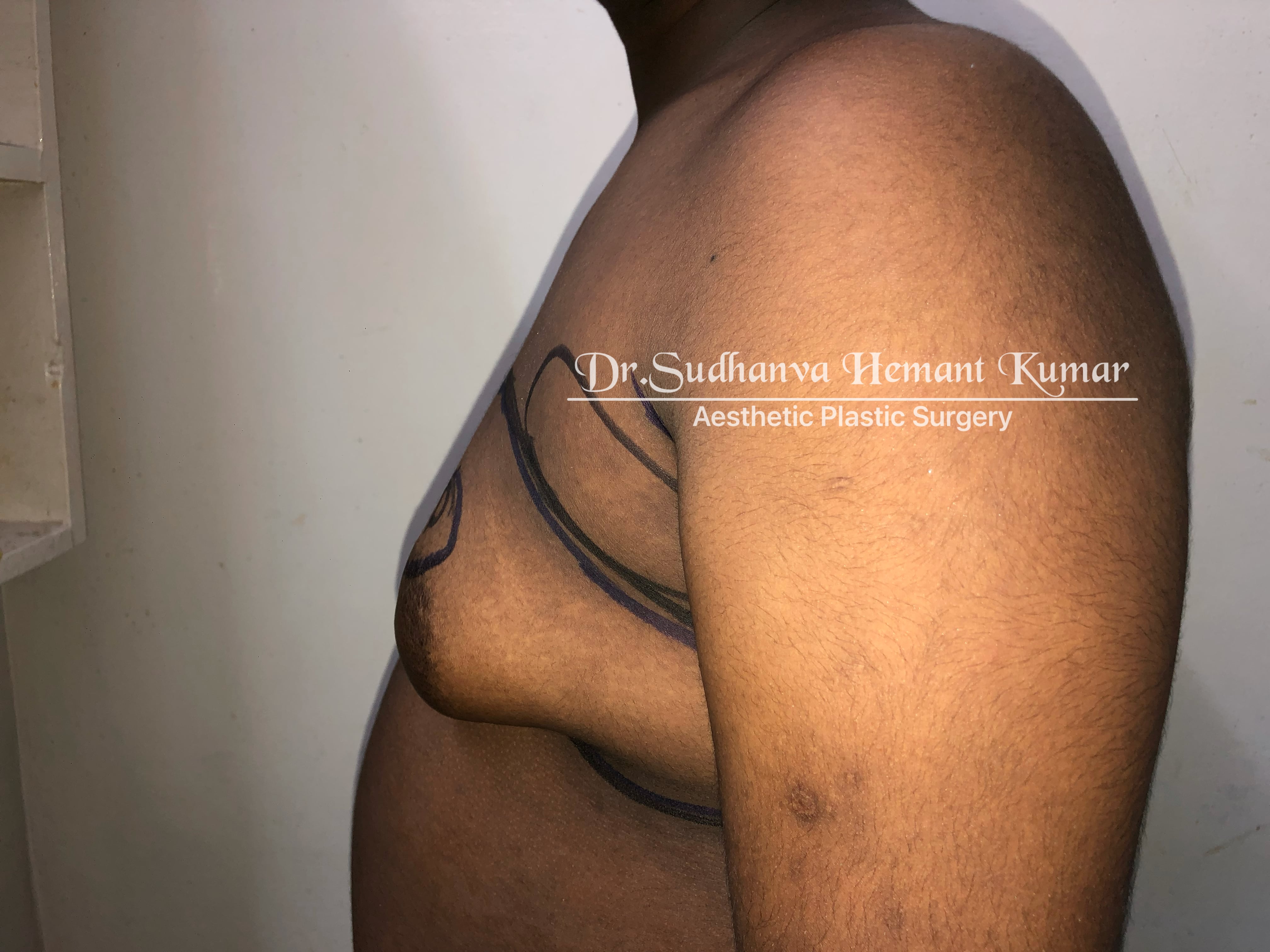 best male boobs reduction in mumbai dr Sudhanva