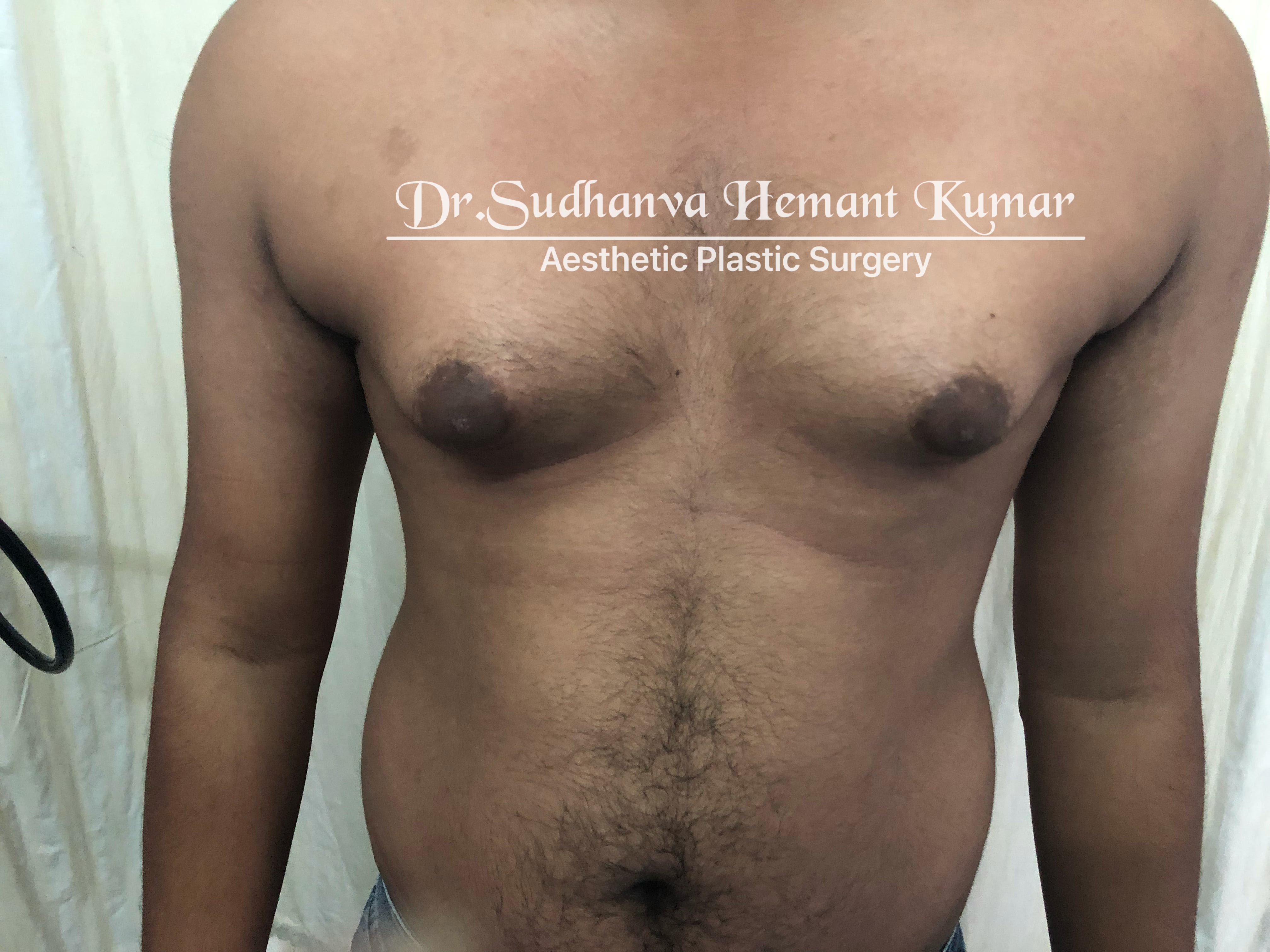 top male breast reduction surgery in india