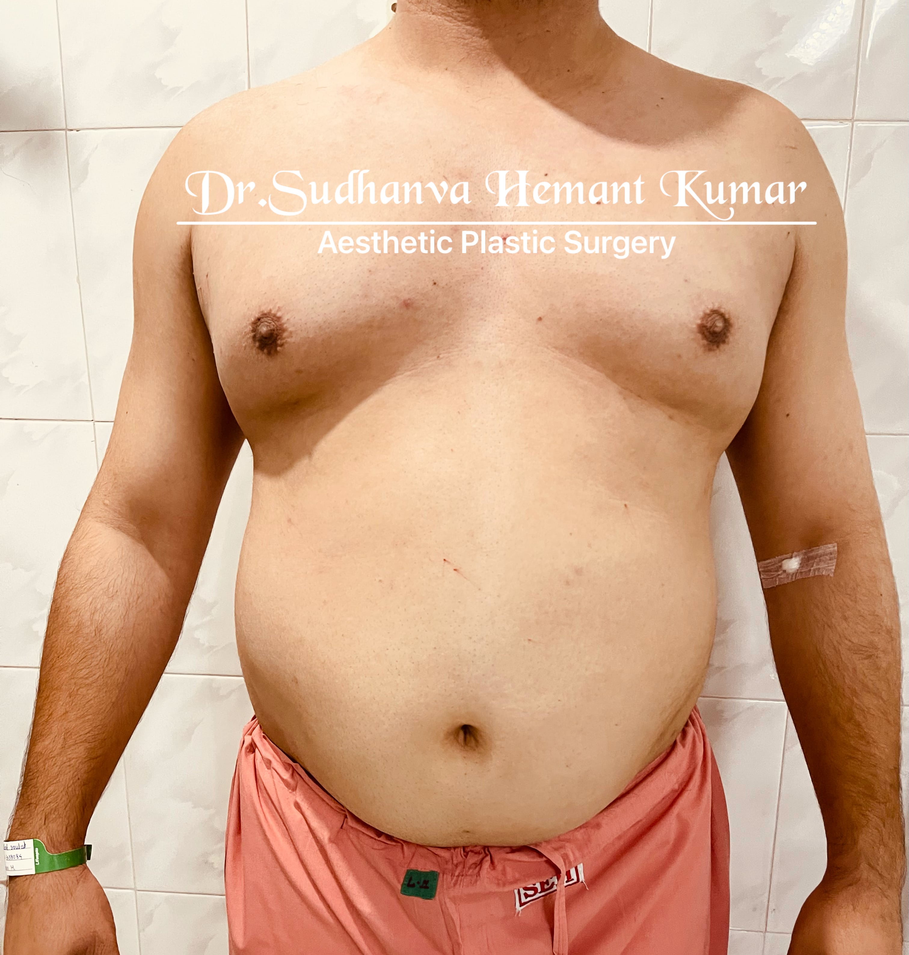 top moobs surgery in india