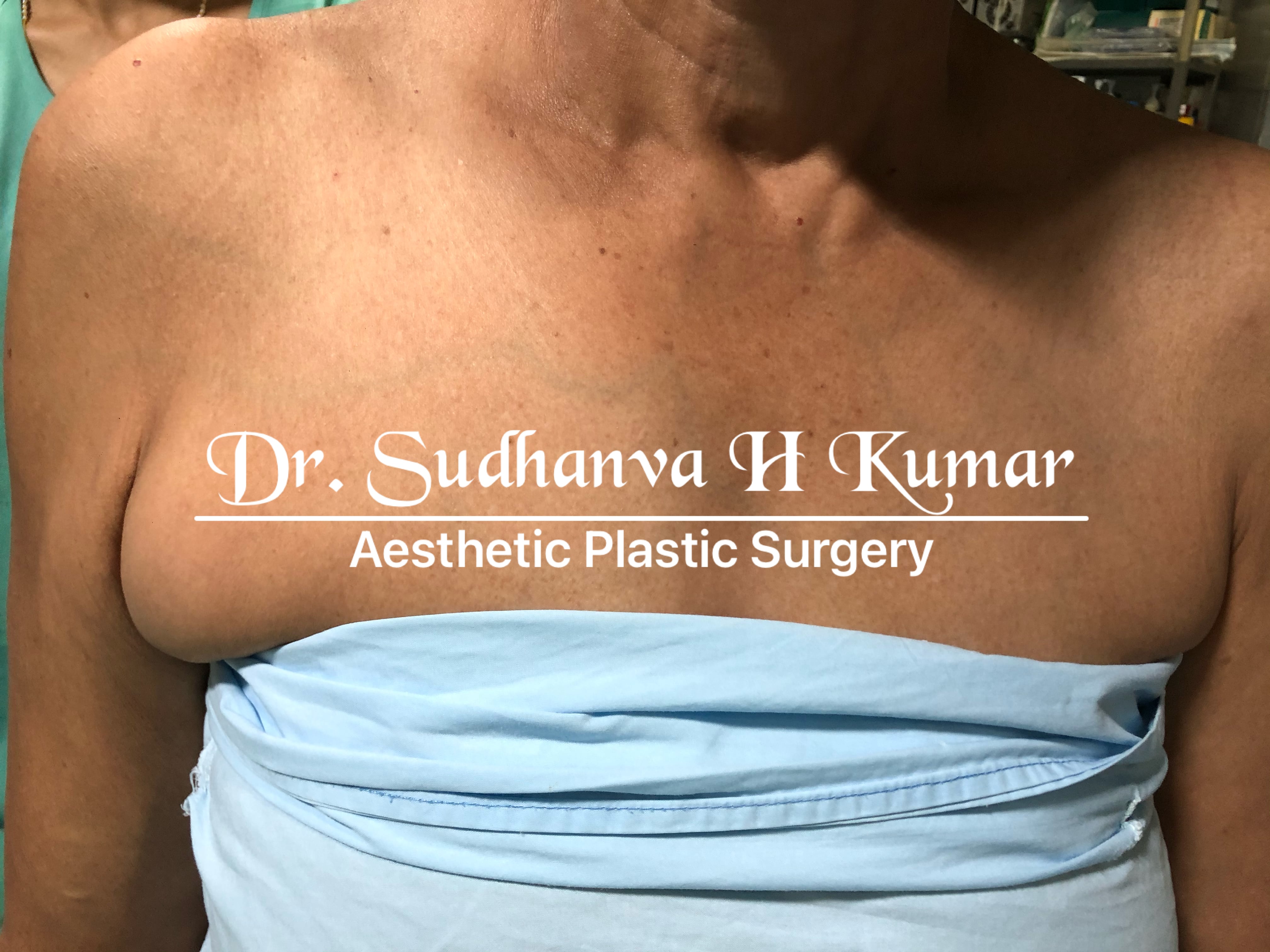 Armpit Fat Removal, Bra Bulge Removal Surgery, Axillary accessory breast  tissue removal