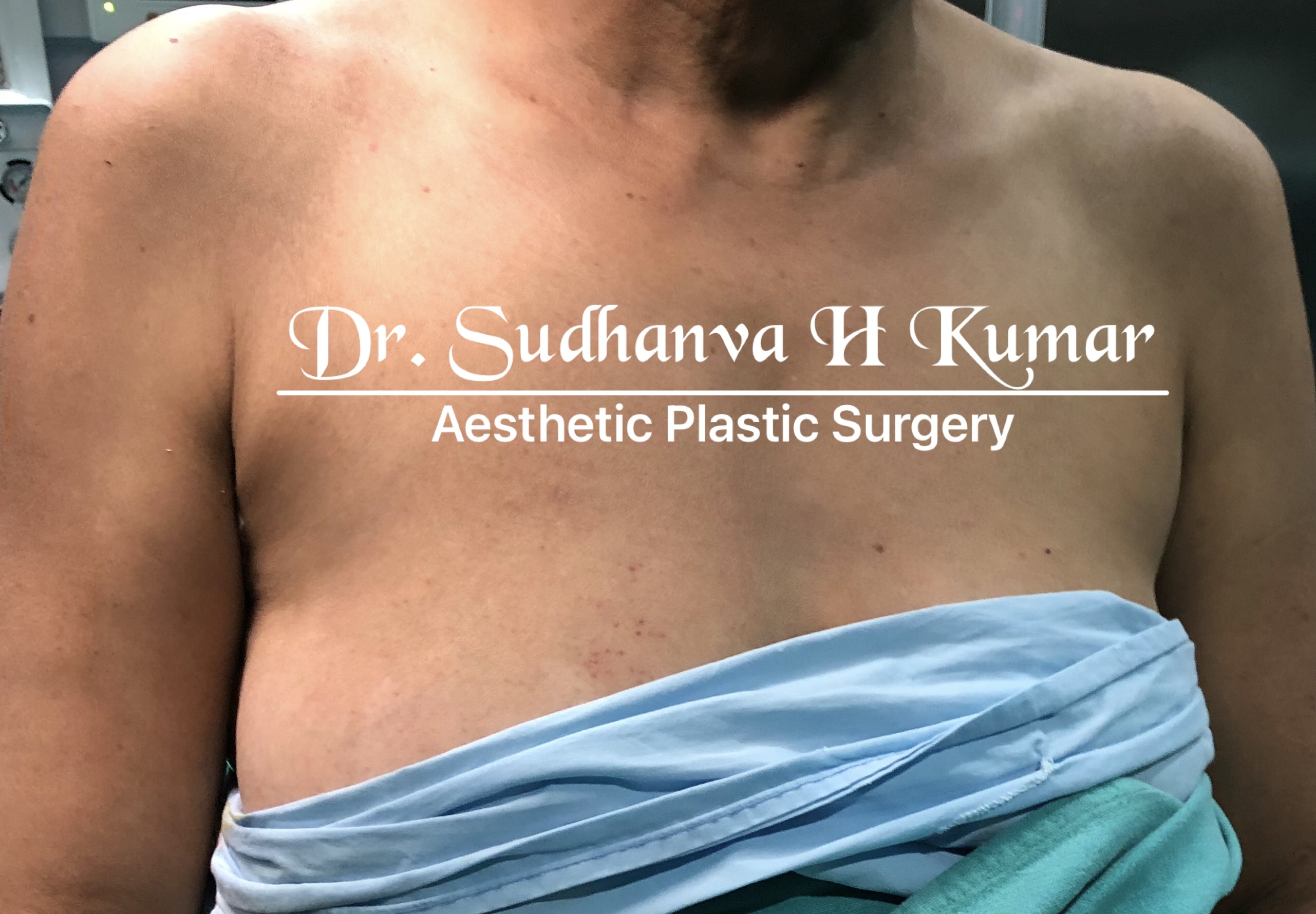 Armpit Fat Removal Surgery in India - Dr. Sudhanva