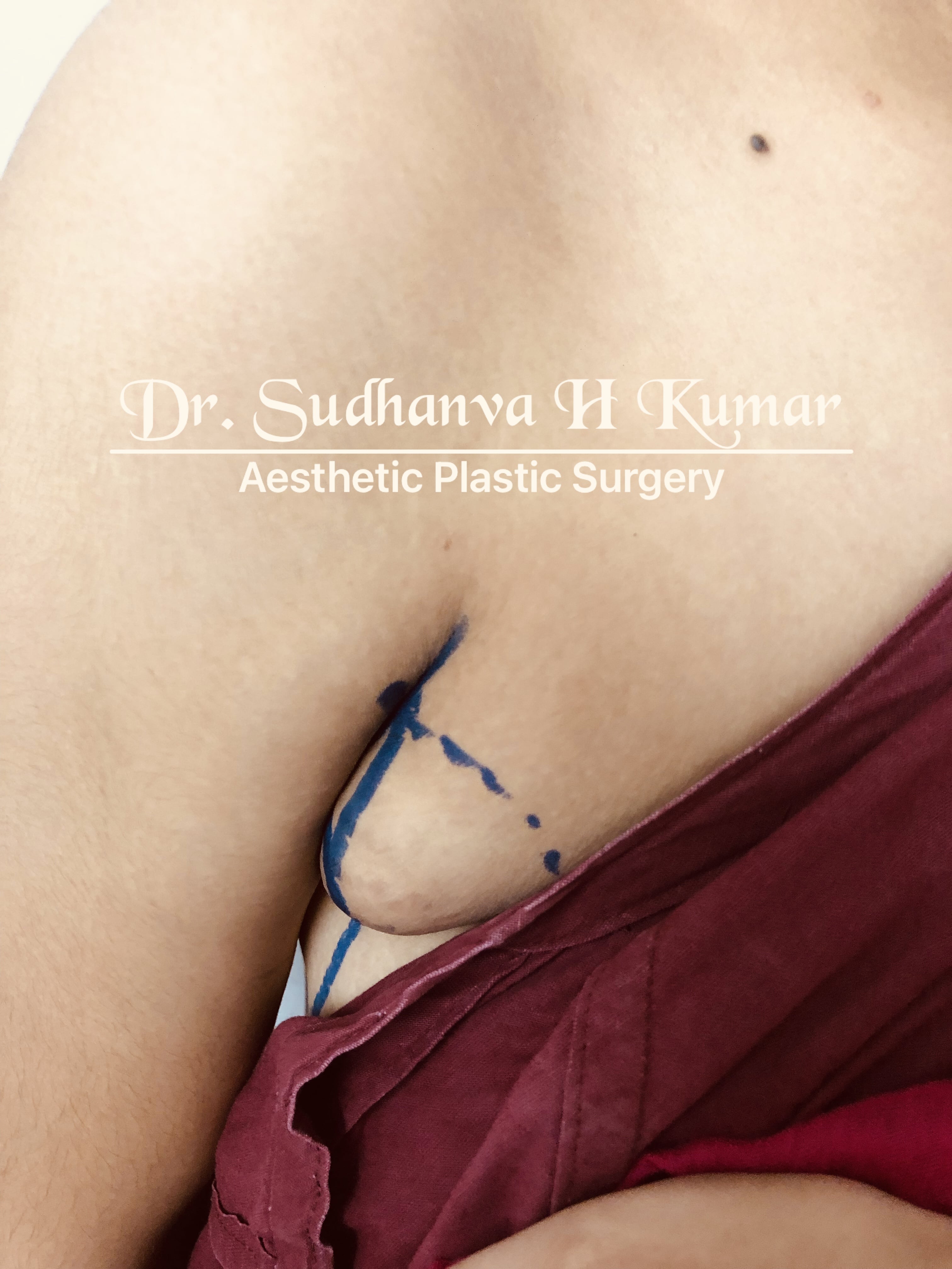 Side Armpit Fat Removal Surgery - Dr. Sudhanva
