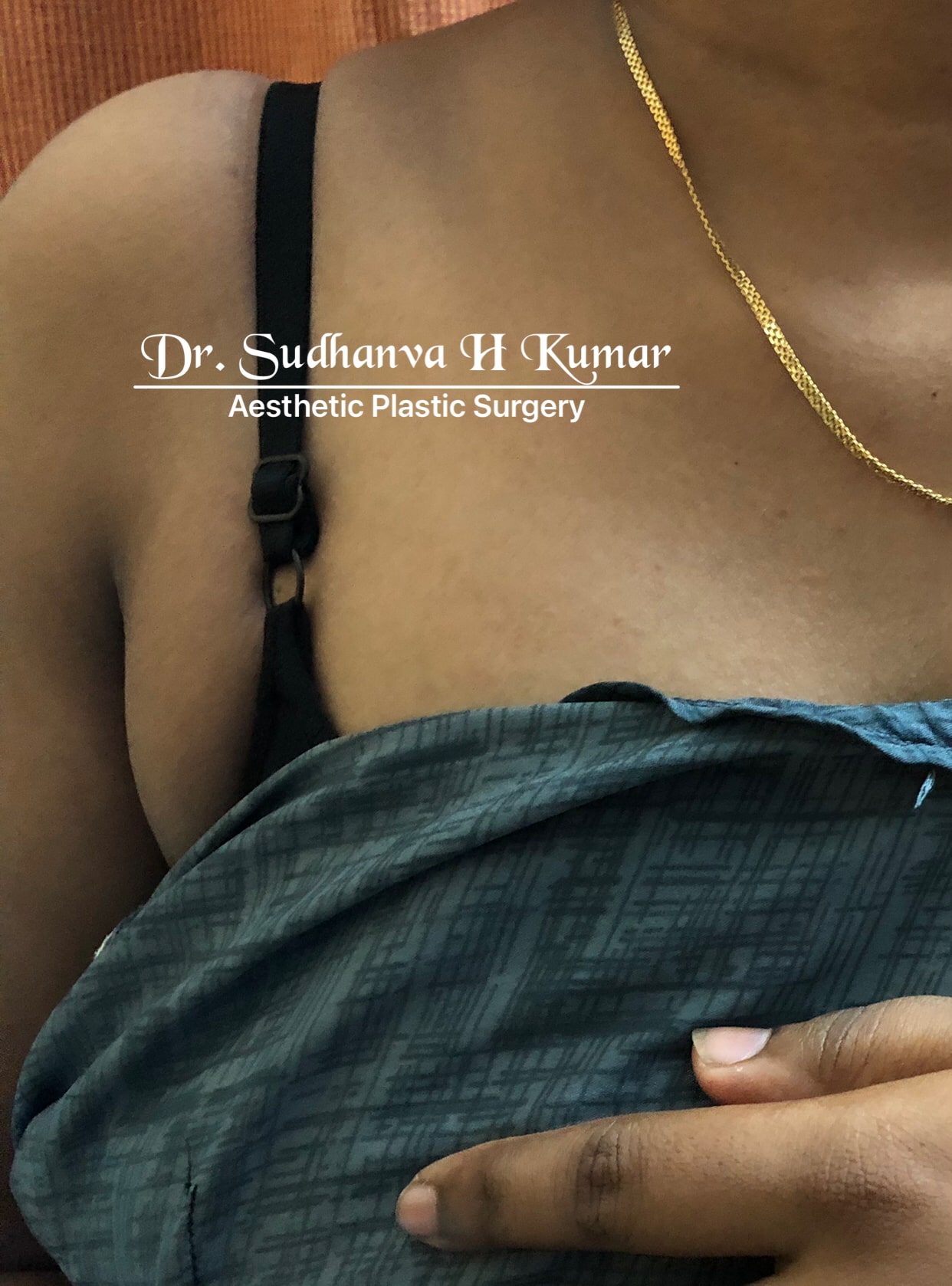 Best armpit fat removal surgery - Dr. Sudhanva