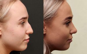 before and after nose lob