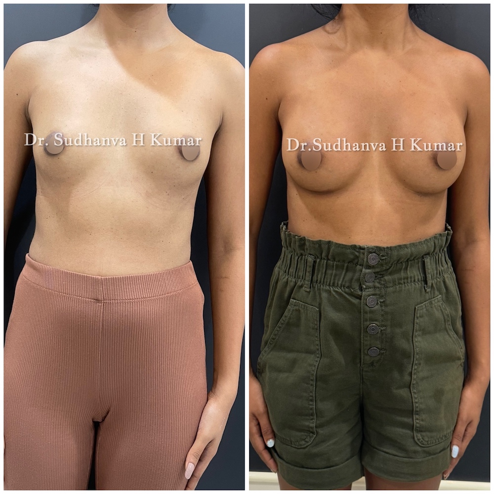 Hybrid Breast Augmentation in Mumbai Before and after pics