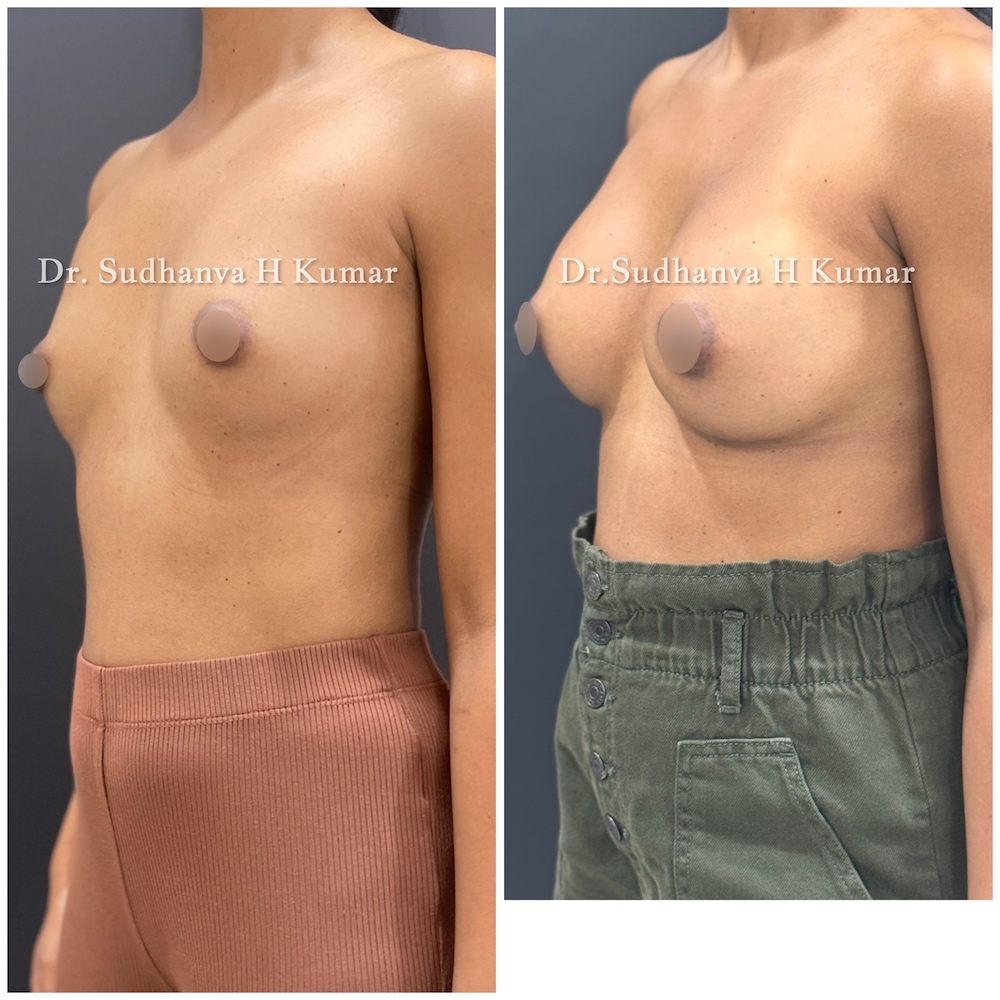 Hybrid Breast Augmentation in Mumbai, India Before and after pics