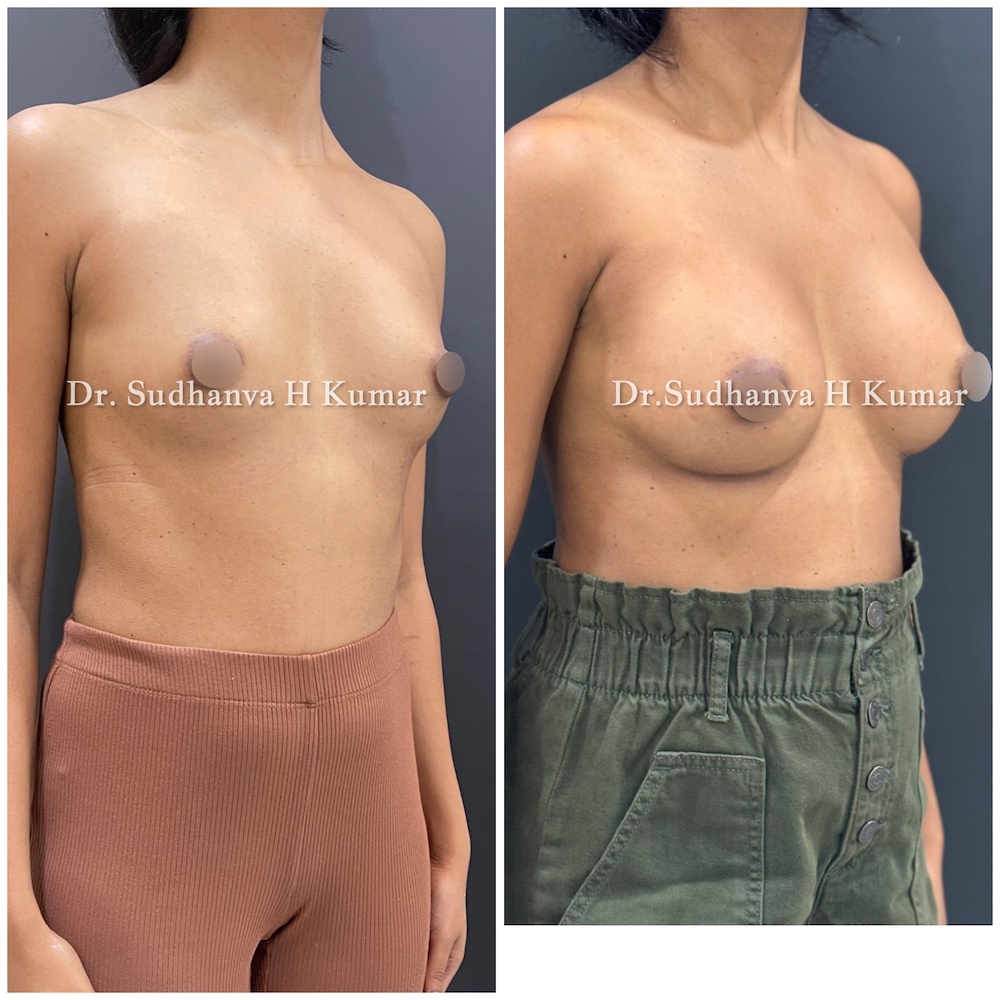 Hybrid Breast Augmentation in India Before and after pics