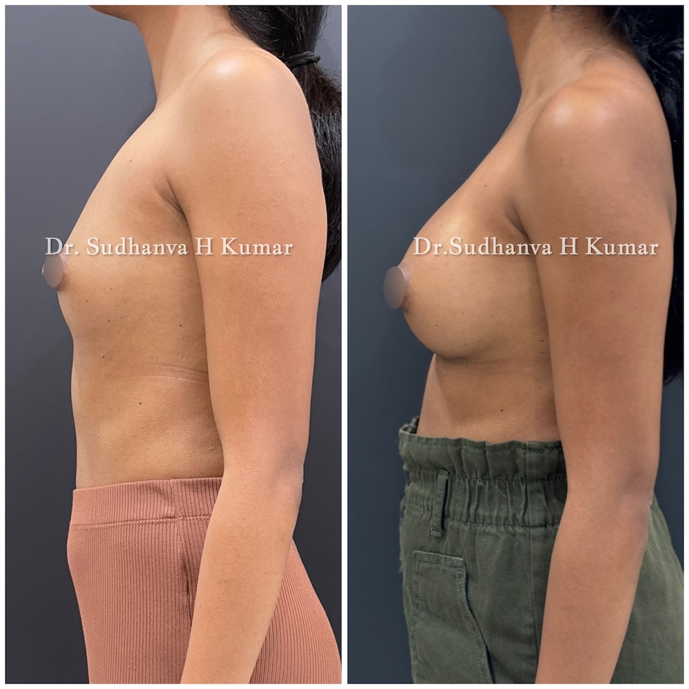 Breast Augmentation in Mumbai Before and after pics