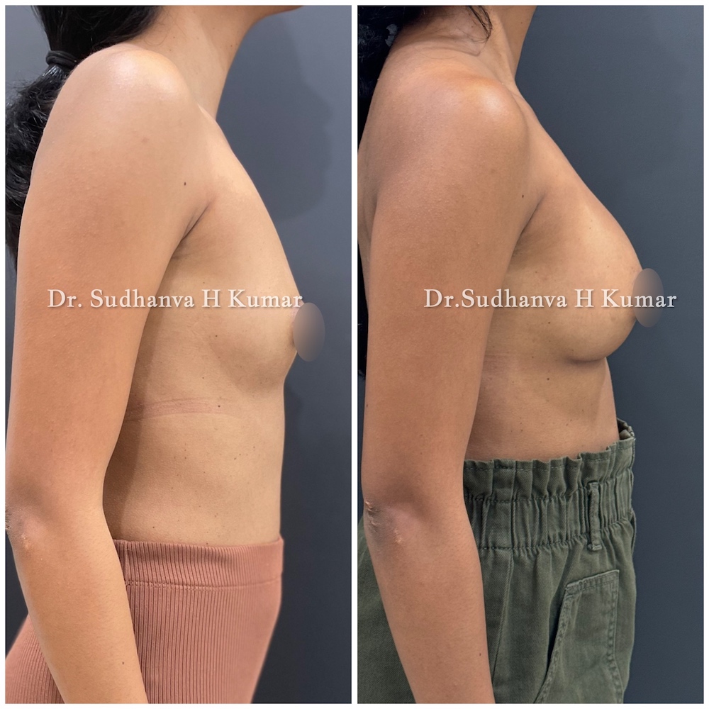 Hybrid Breast Augmentation in Mumbai Before and after pics