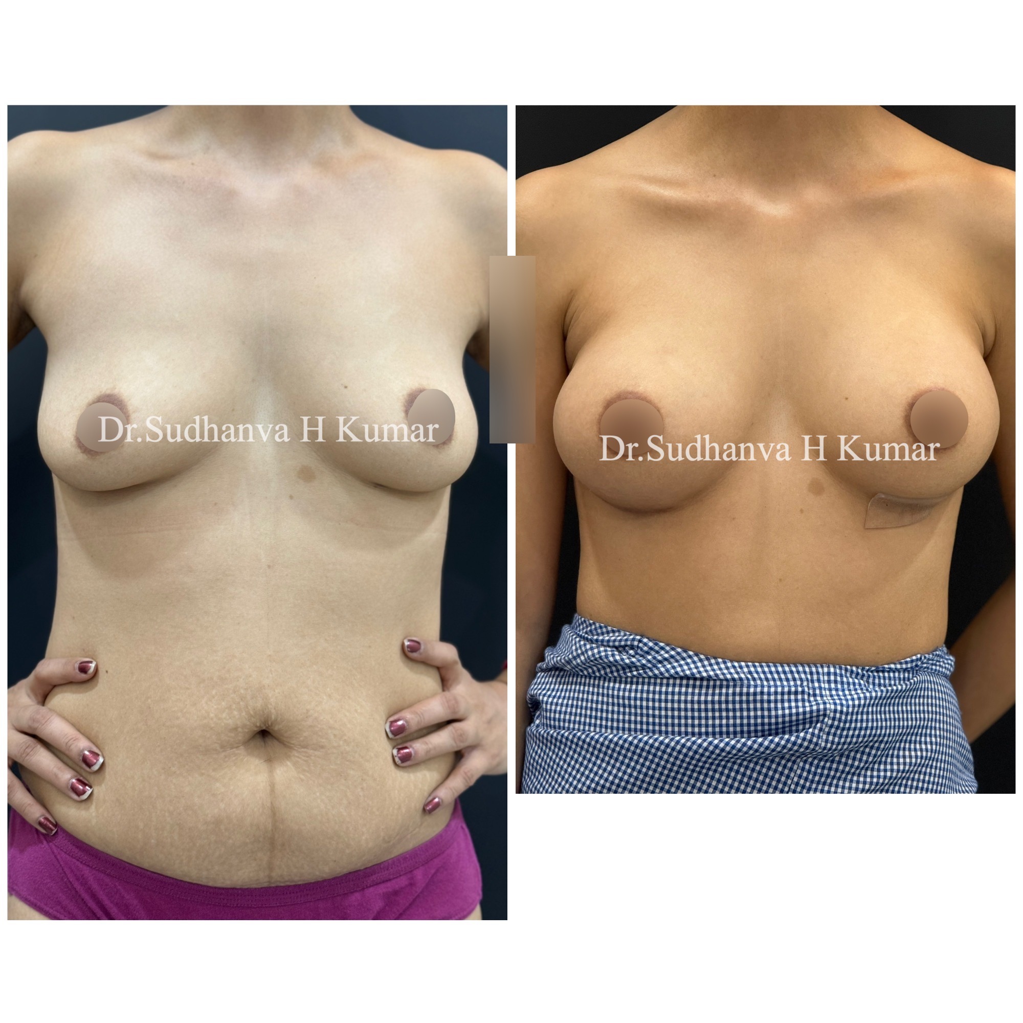 Breast augmentation Before After