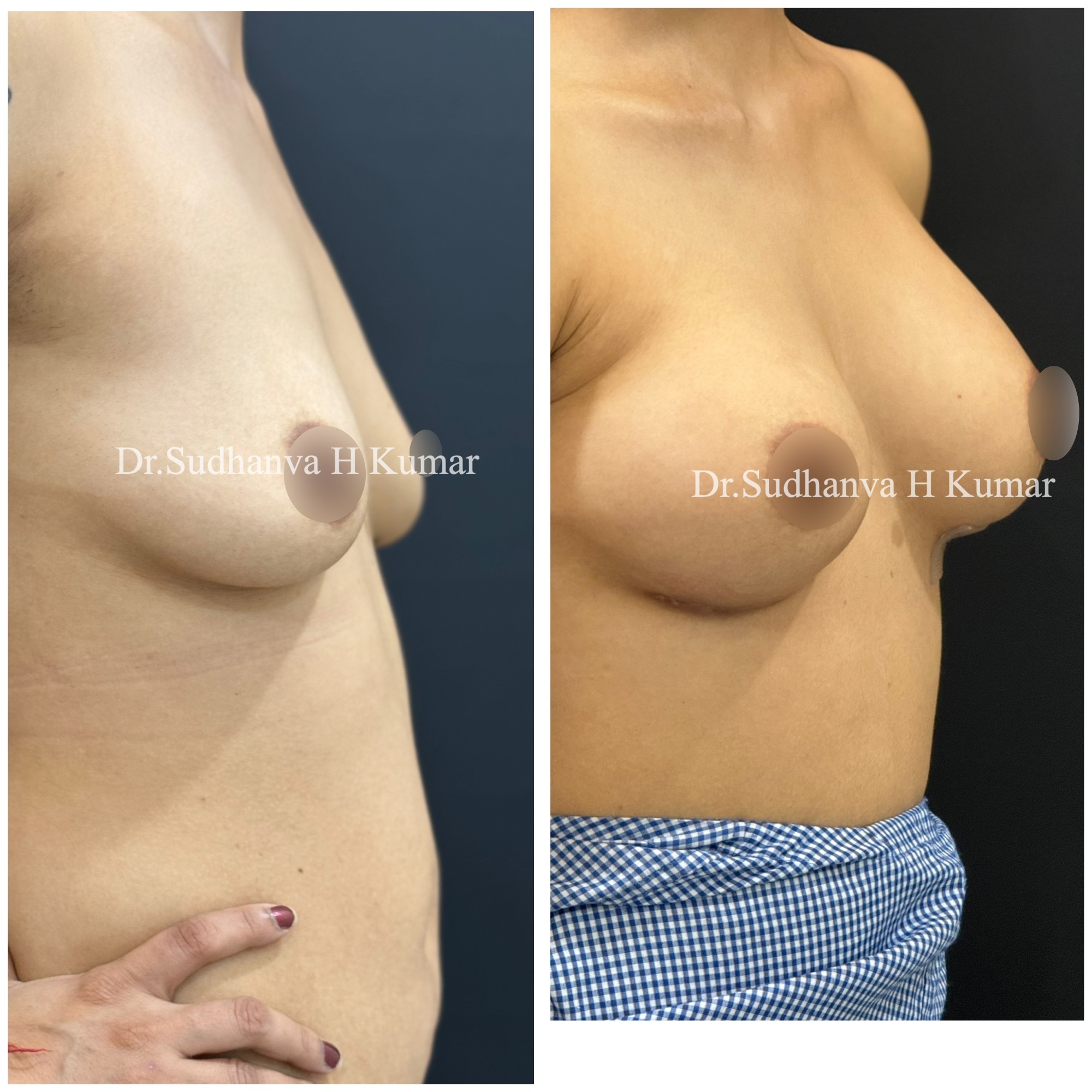 Breast augmentation with implants Before After