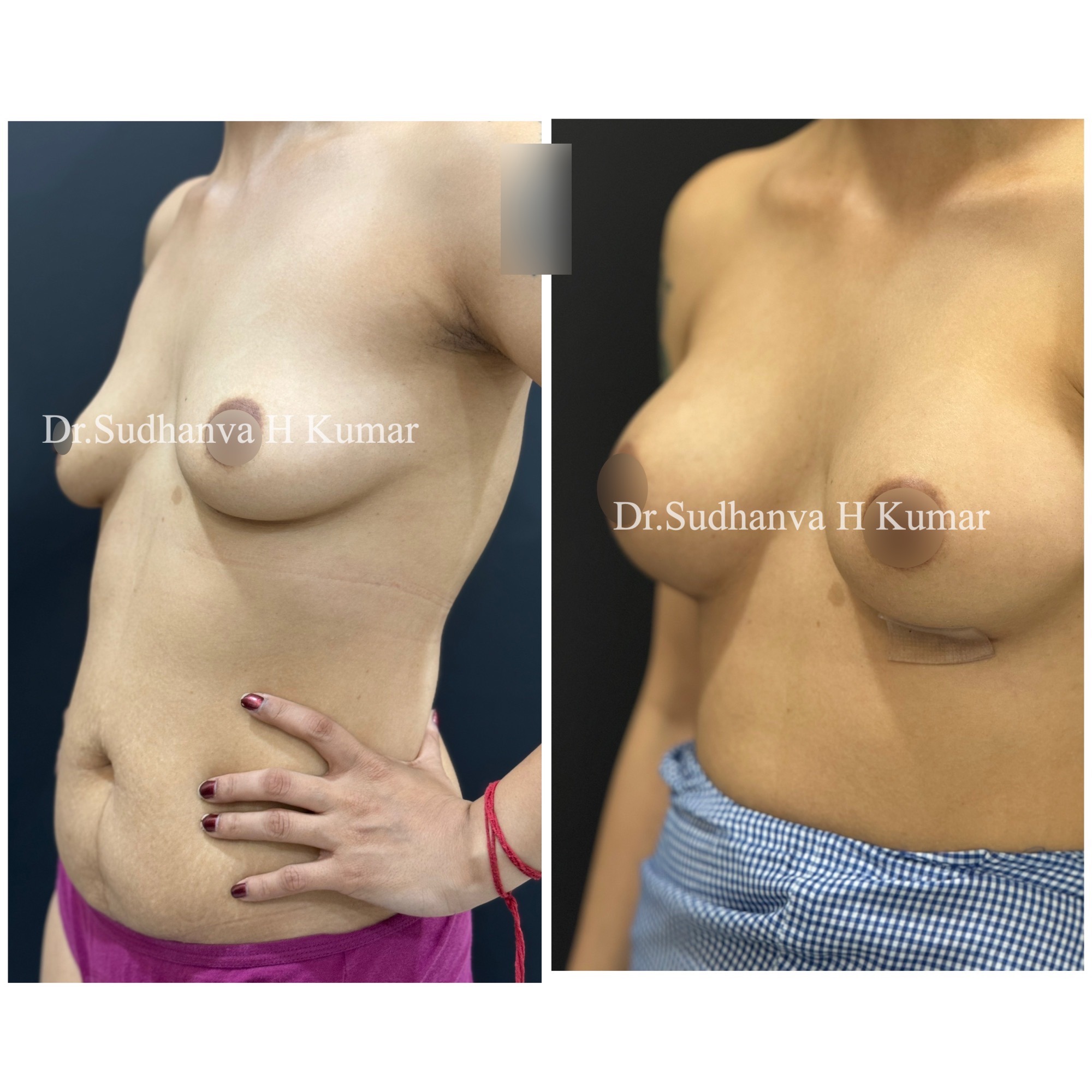 Breast augmentation in India Before After