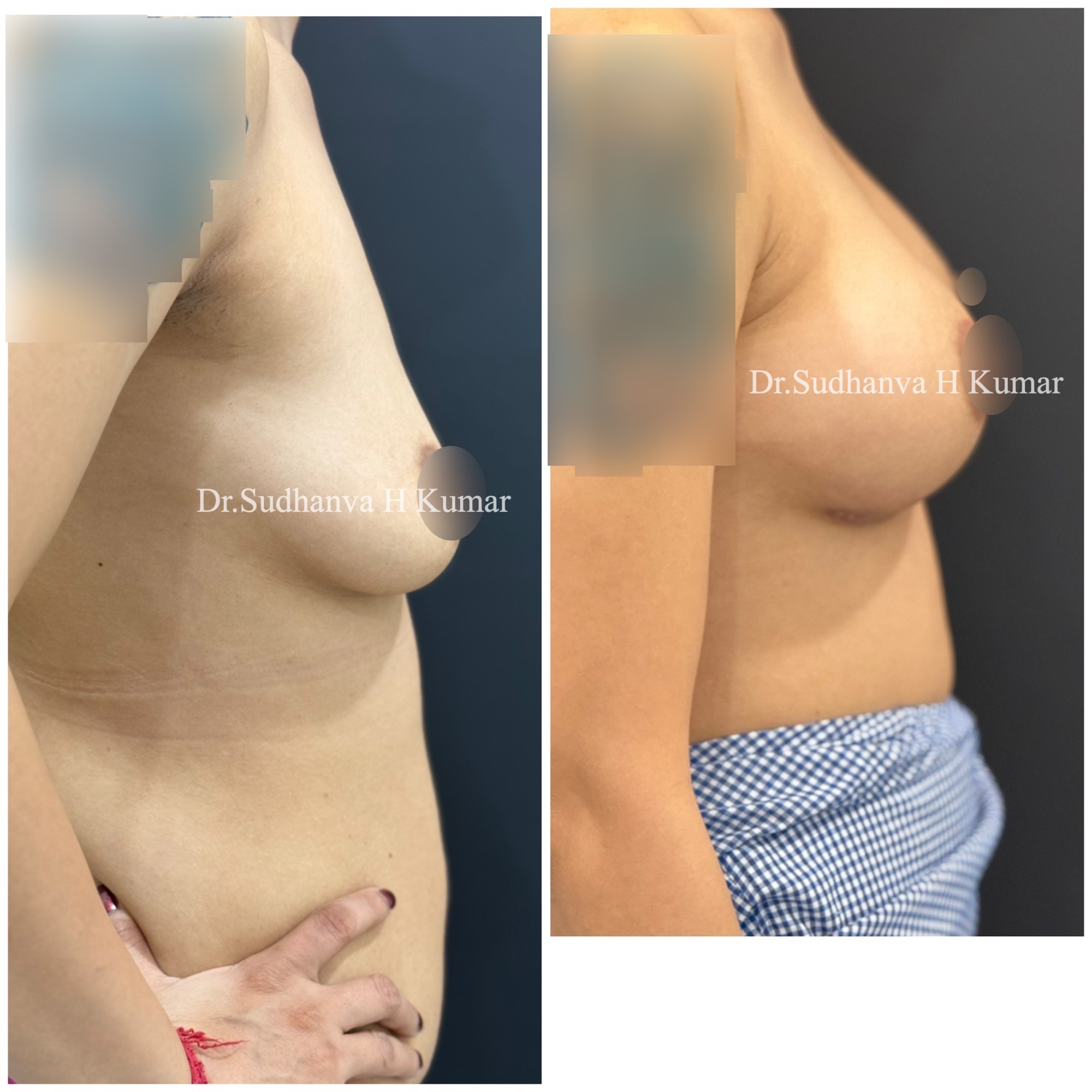 Breast augmentation in india Before After