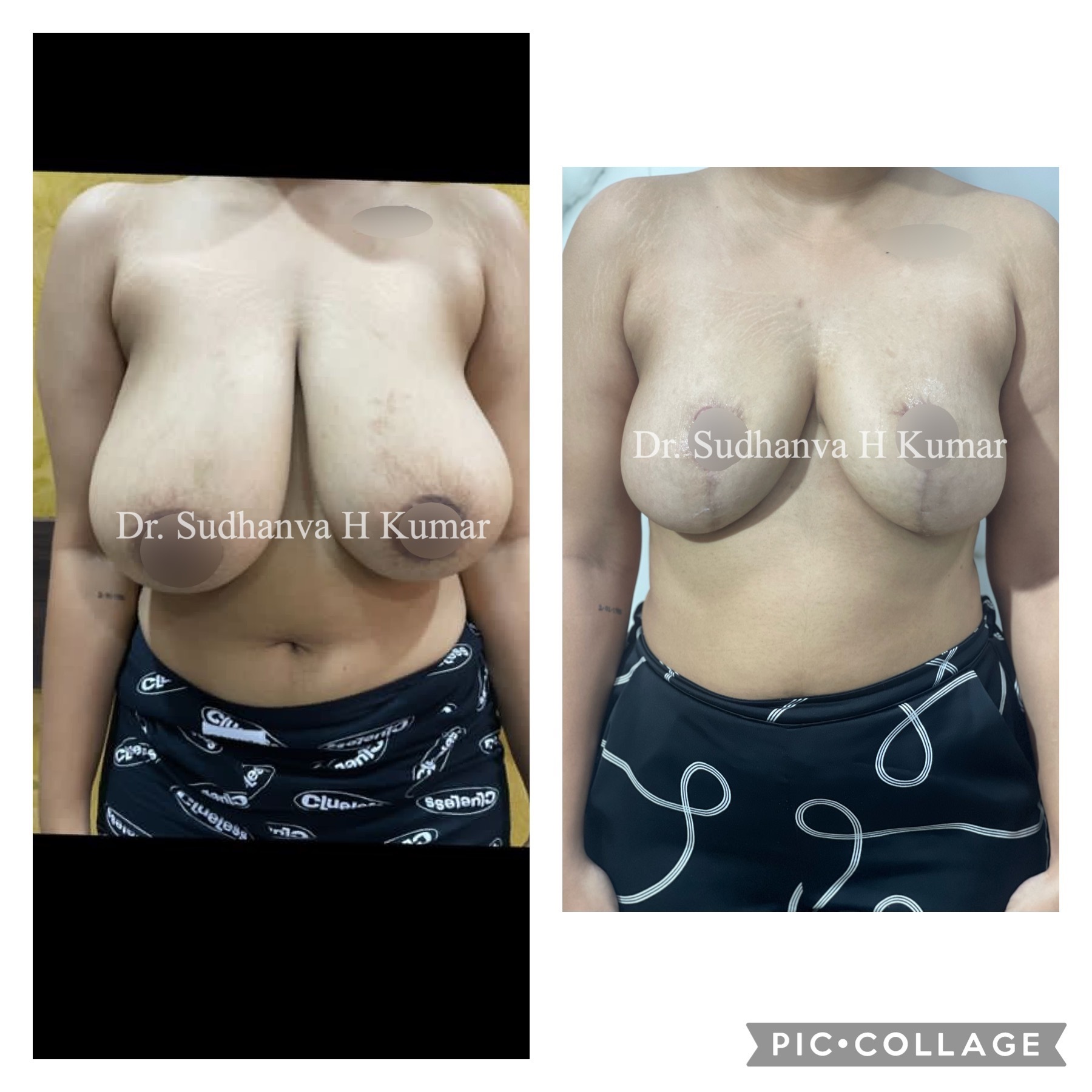 Breast Reduction in India Before/ After