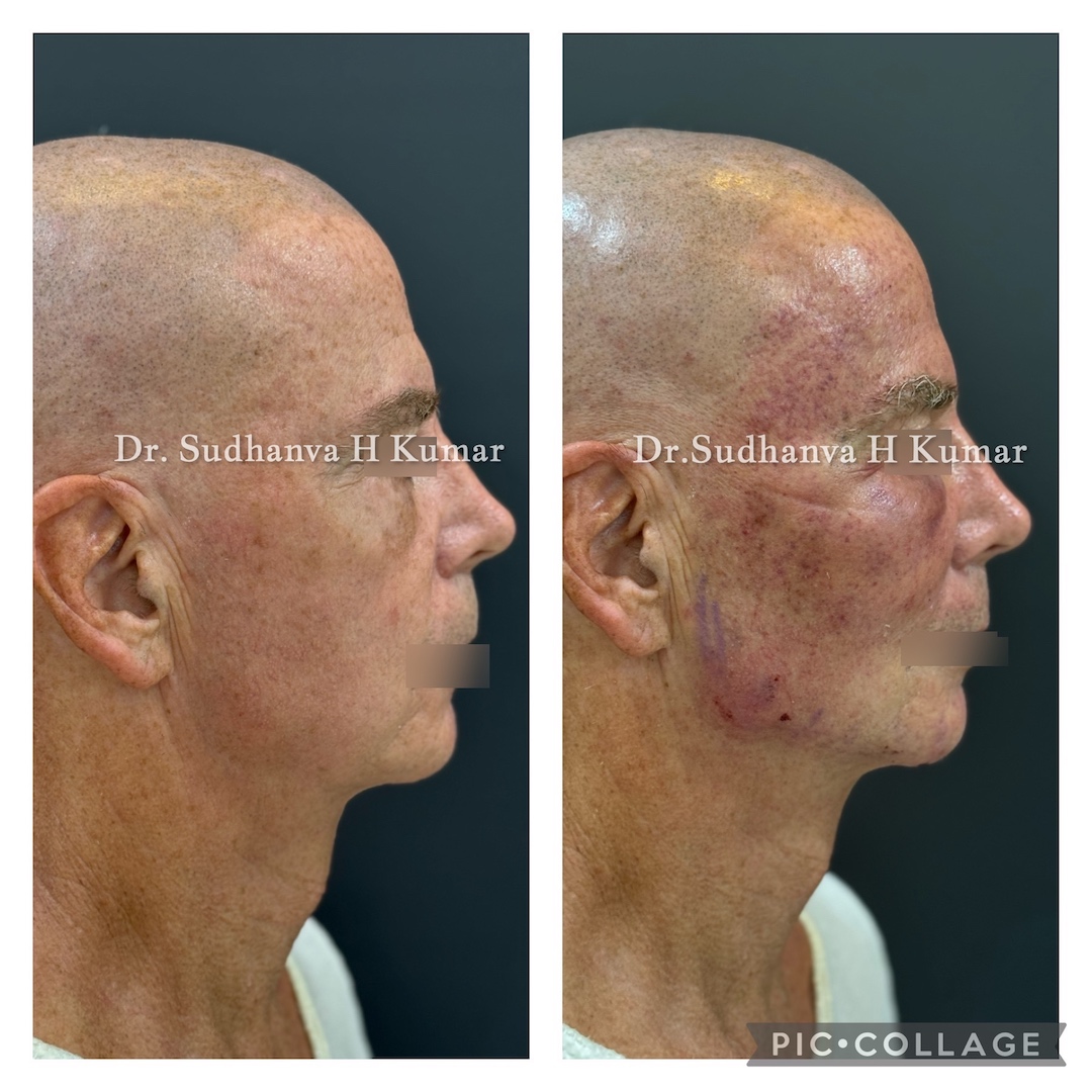 Fat Transfer to Face Before/ After with micro needling