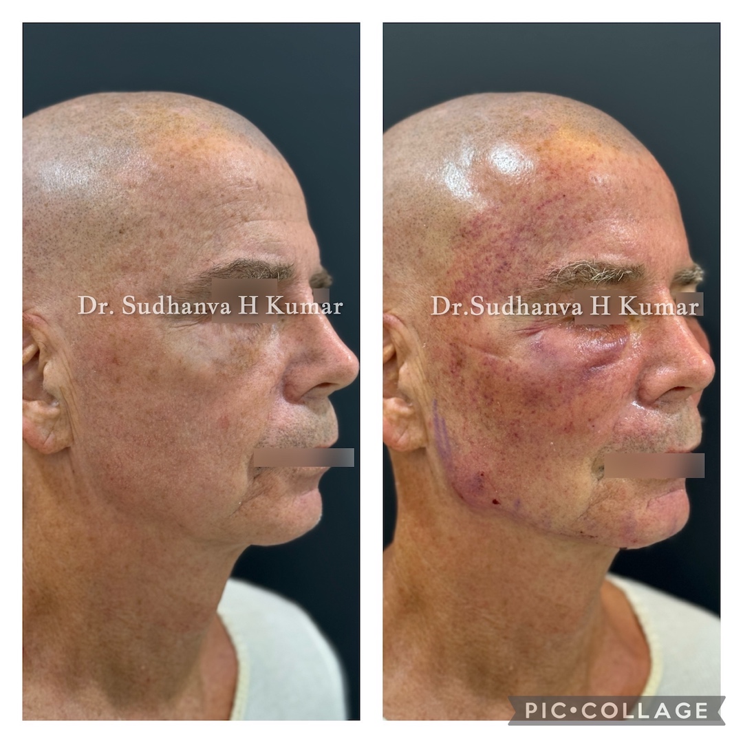 Fat Transfer to Face before & After pics