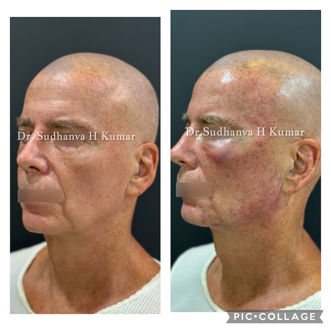 Fat Transfer to Face Before & After