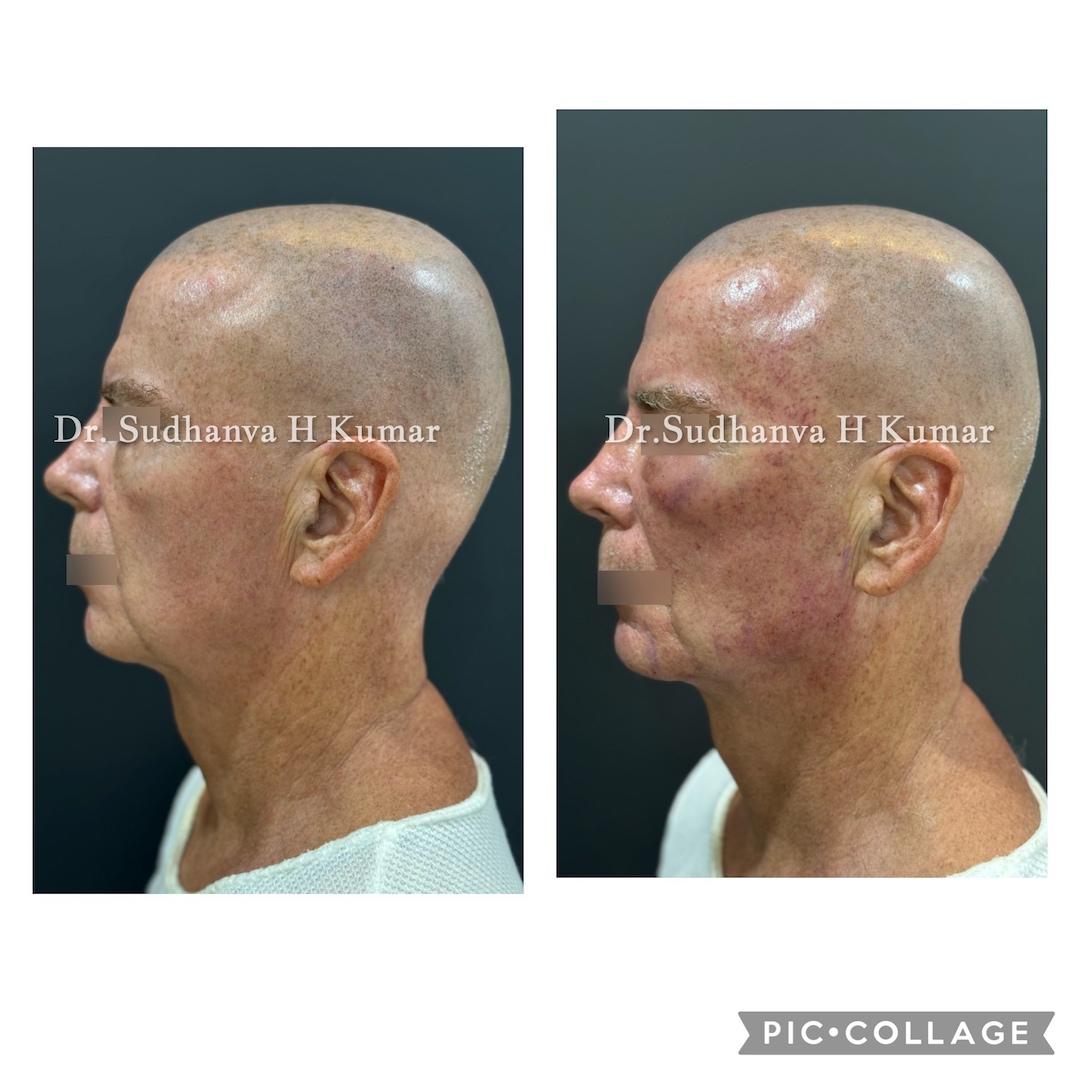 Fat Transfer to Face Before/ After