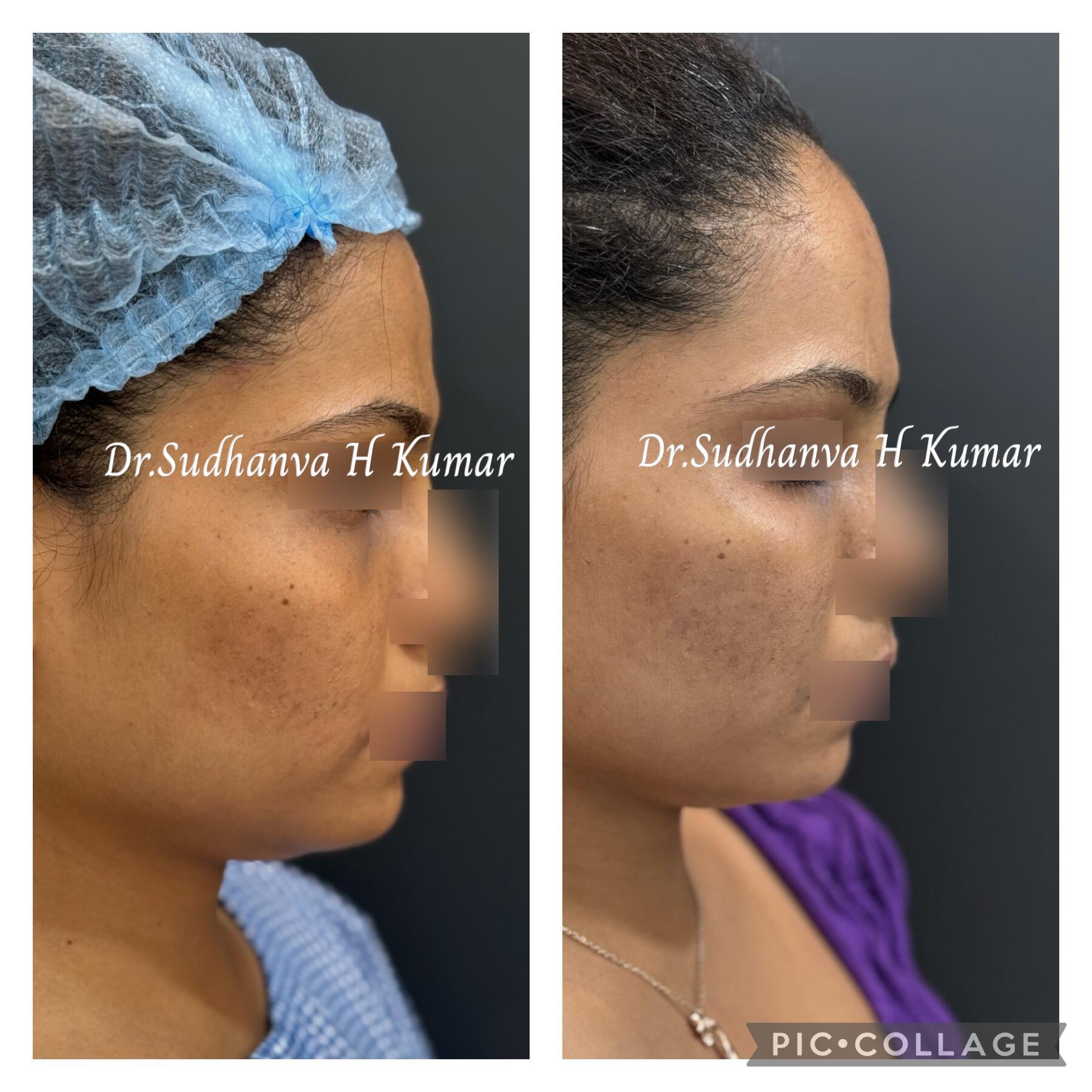 fat transfer in Mumbai, India under eye & cheeks before after