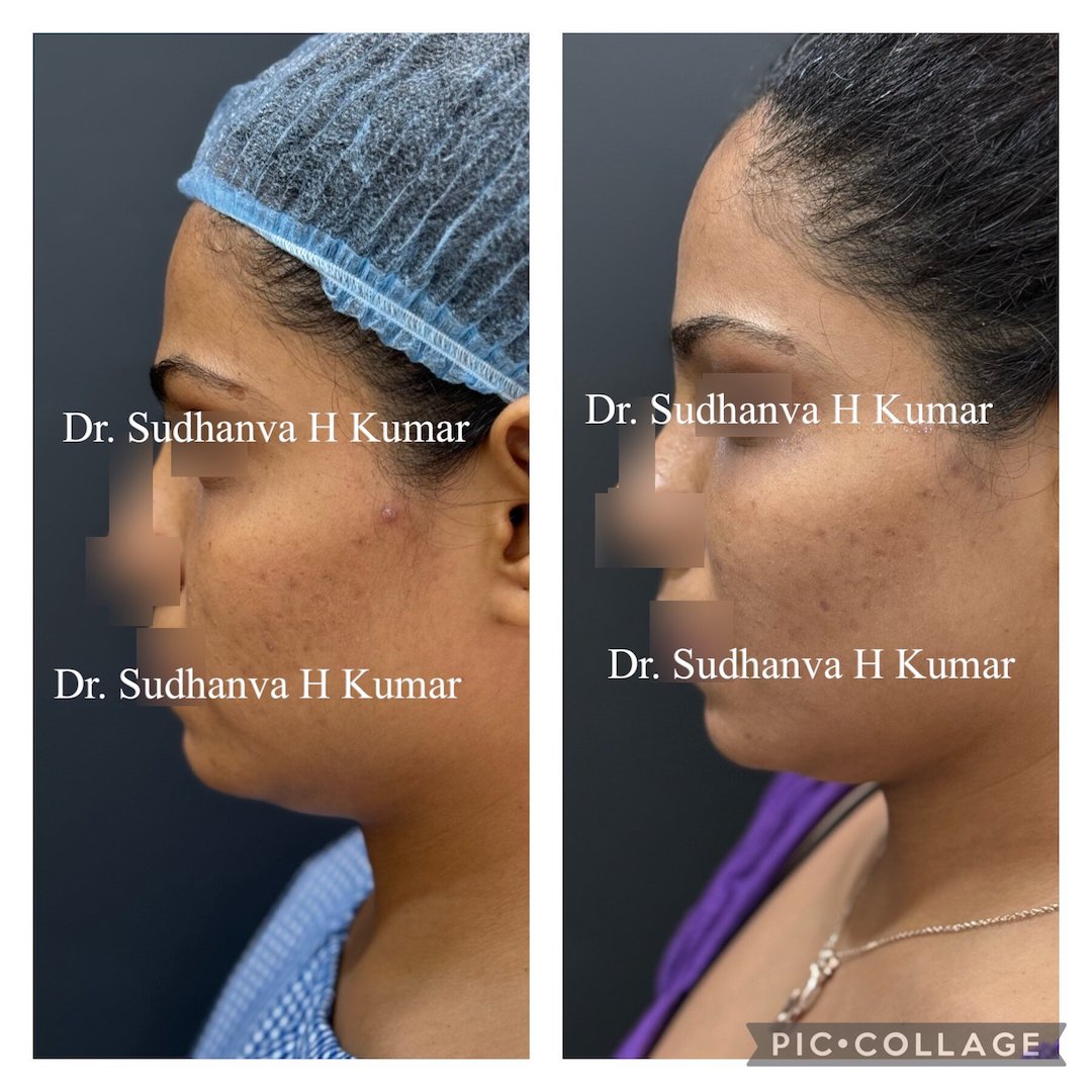 fat transfer in Mumbai, India under eye & cheeks before after