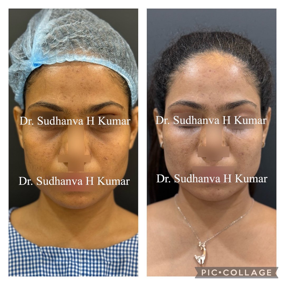 fat transfer in Mumbai, India under eye & cheeks before after