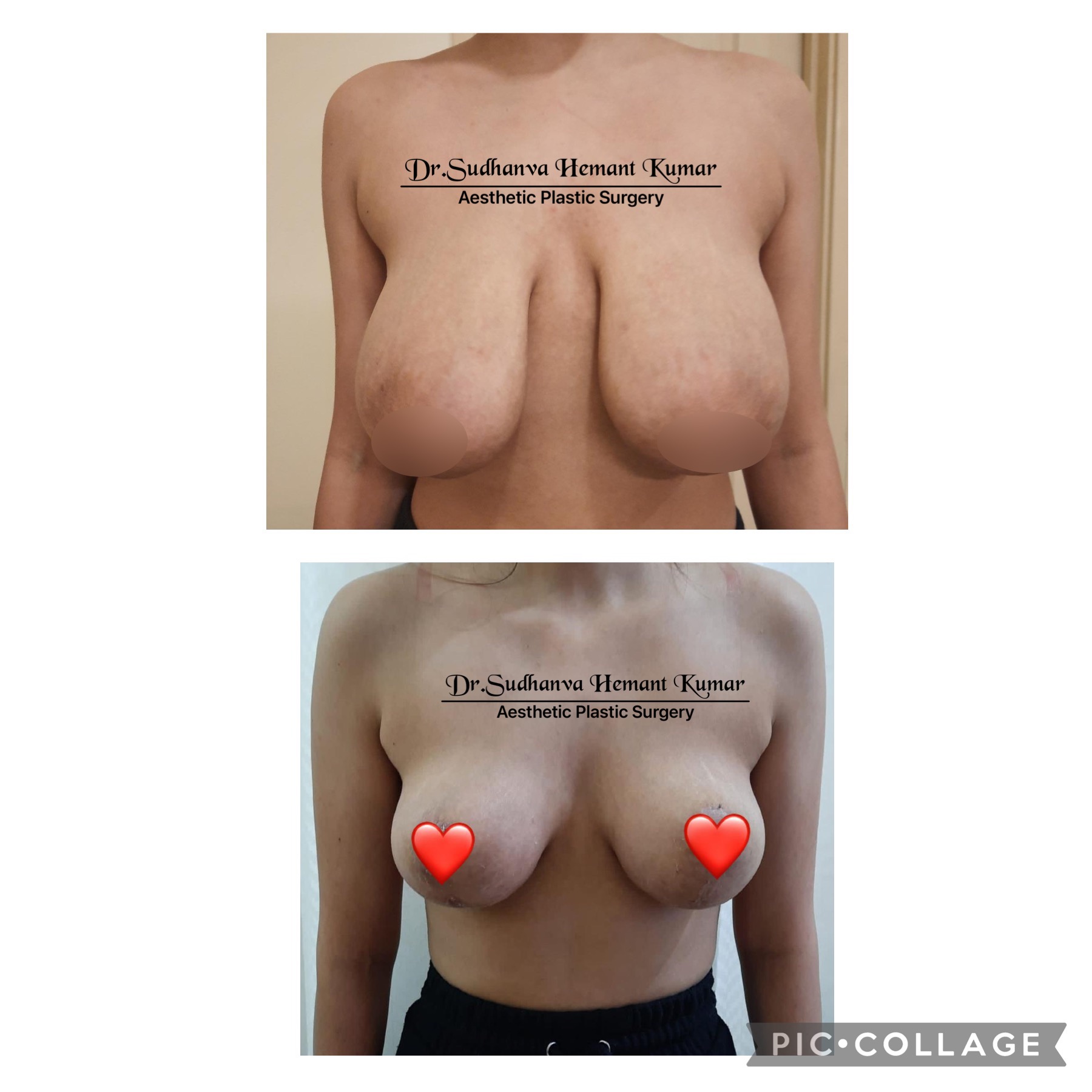 Breast reduction in mumbai before/after