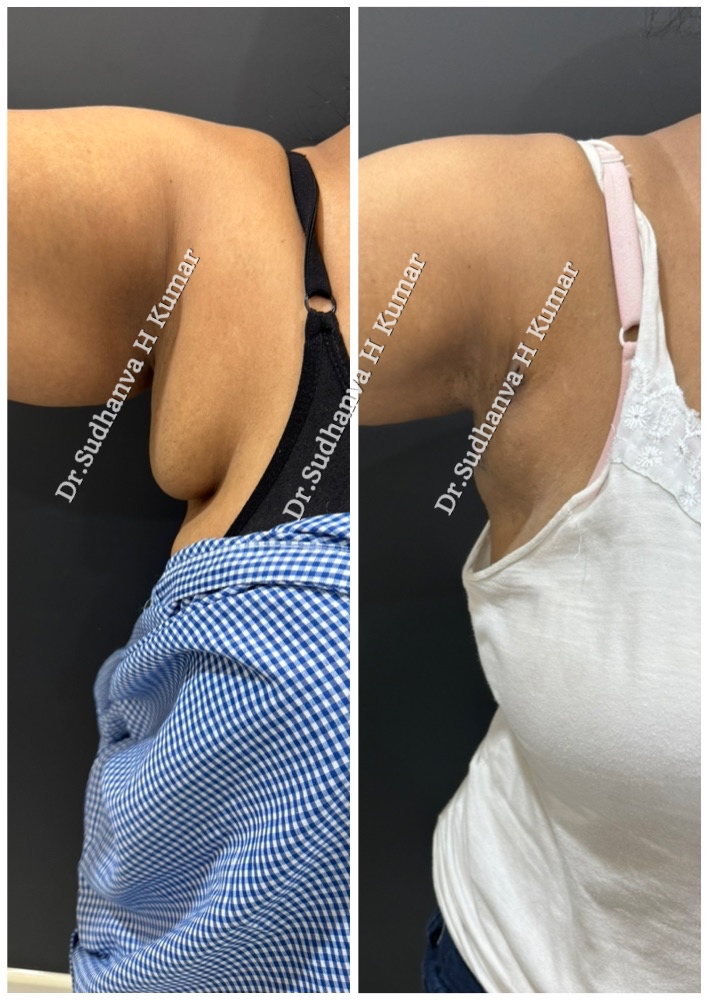 Large axillary breasts treatment in Mumbai right side