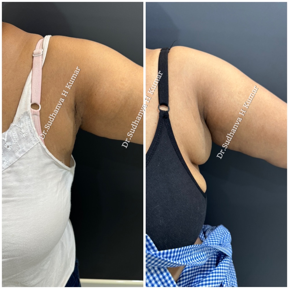 Left side axillary breast correction in mumbai