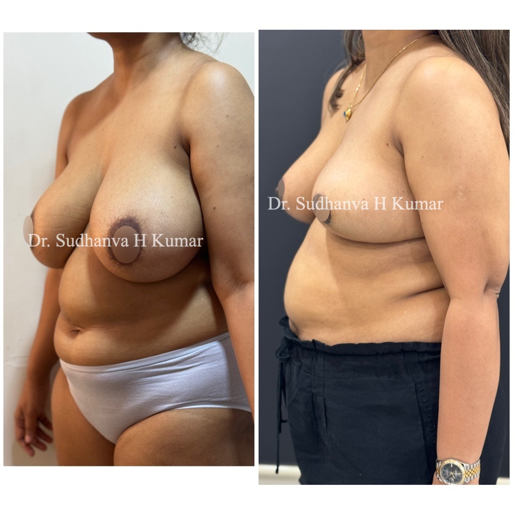 Breast Reduction in Mumbai before & After