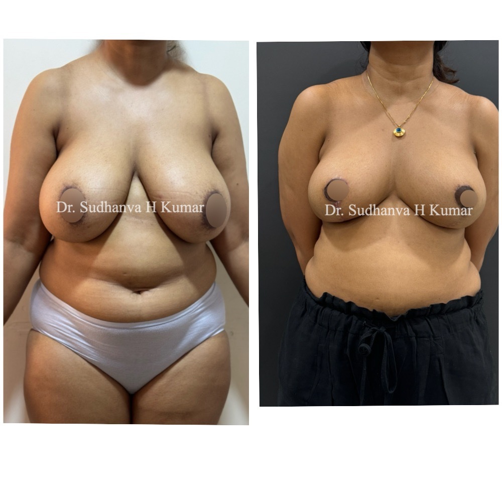 Breast Reduction before & After pictures