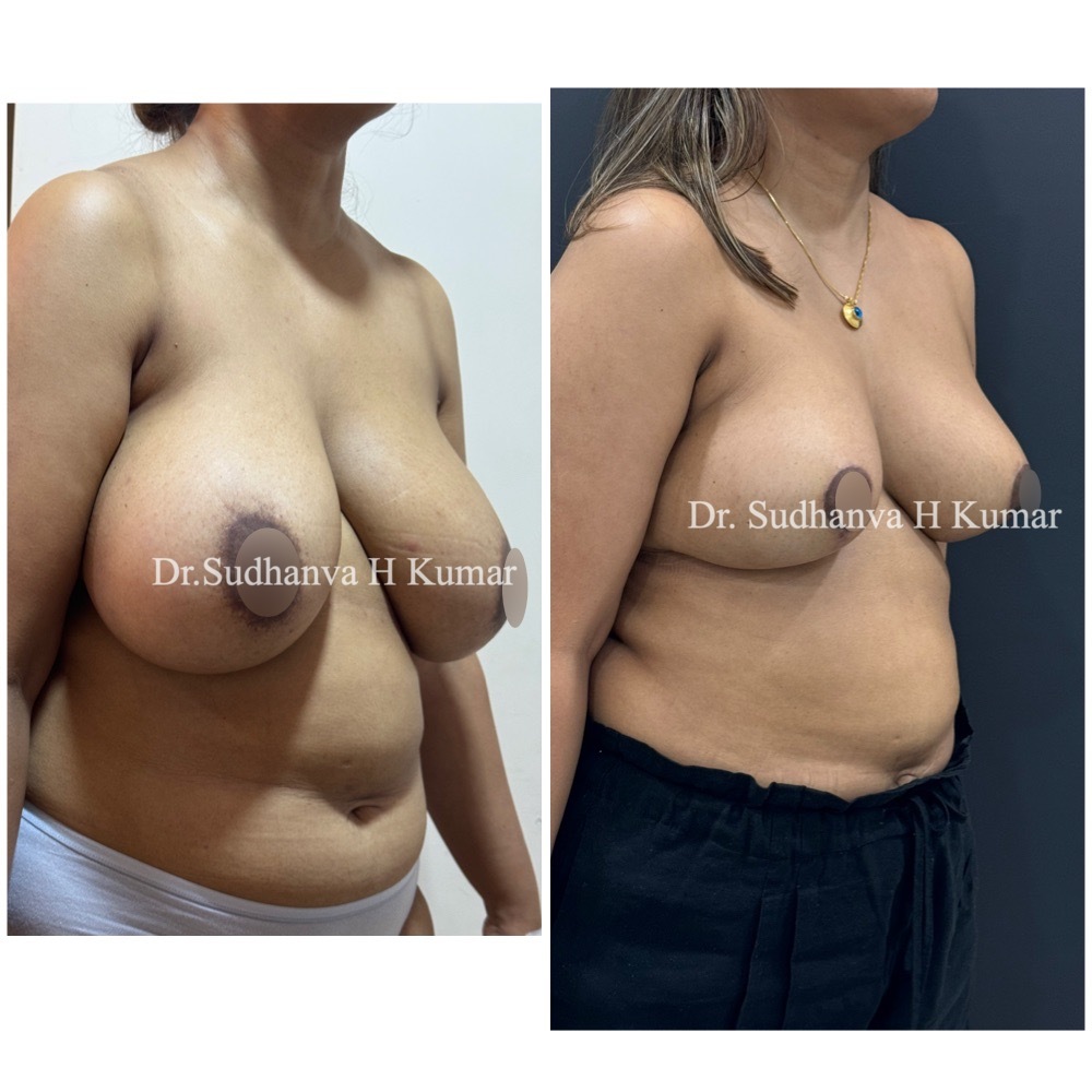 Breast Reduction in India before & After