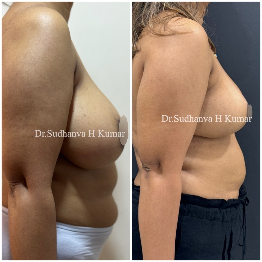 Breast Reduction in Mumbai before & After