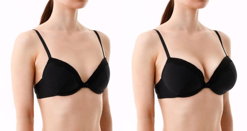 Breast Augmentation