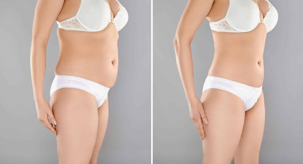 Tummy Tuck Cost in Mumbai
