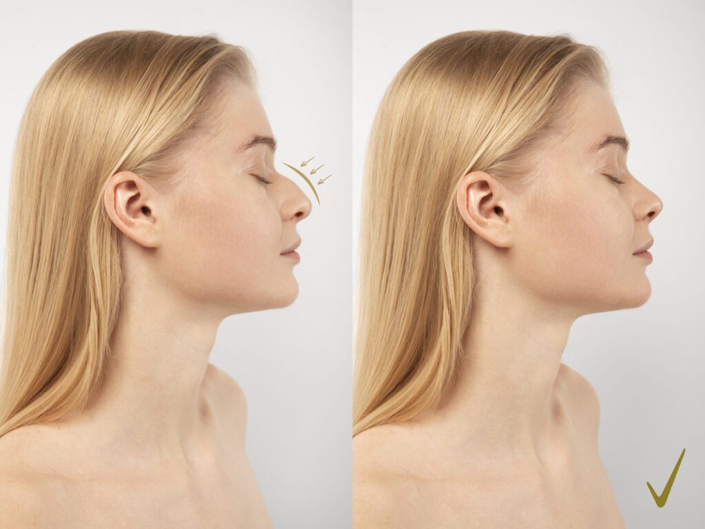 Rhinoplasty Cost in Mumbai