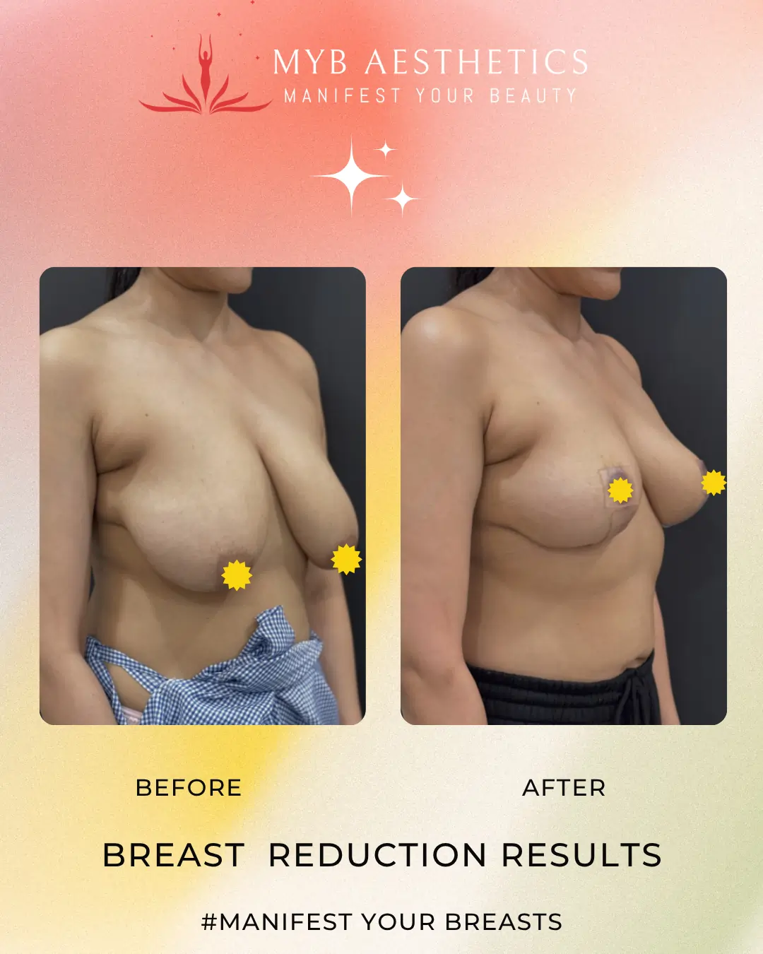 Breast Reduction Result Before & After Image Left side, Best results for Breast Reduction in Mumbai