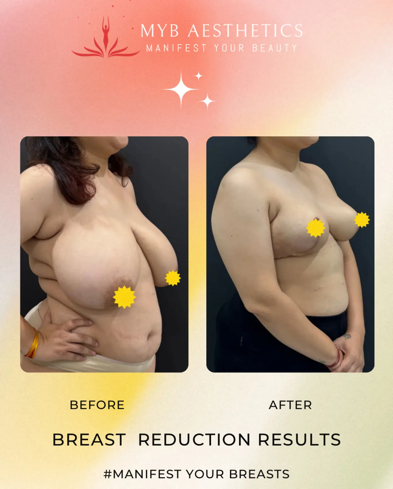 Breast Reduction Results Patient 2 Before and after photo