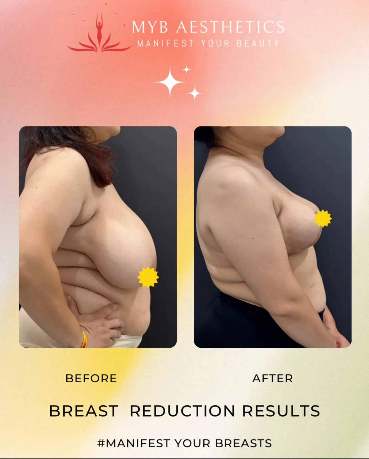 Breast Reduction Results Patient 2 Before and after photo
