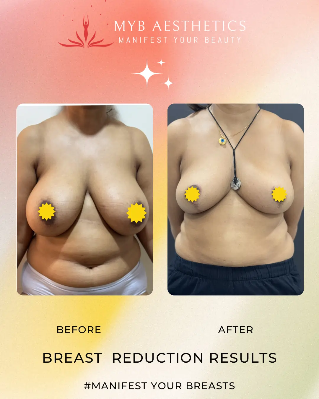 Breast Reduction Results Before & After
