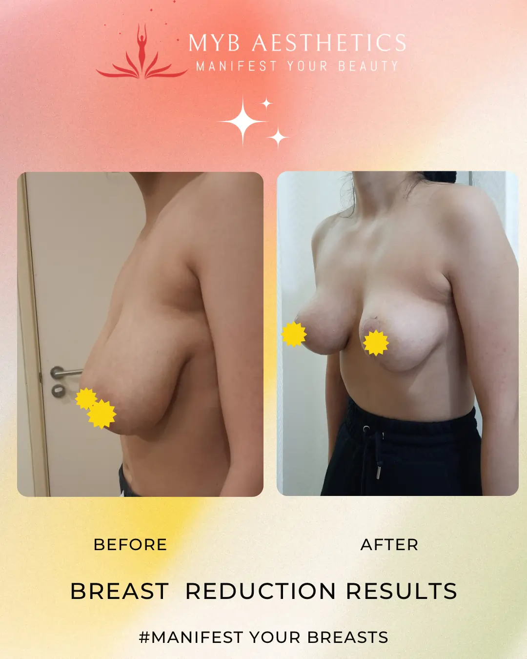 Before & After pics of Breast Reduction Surgery