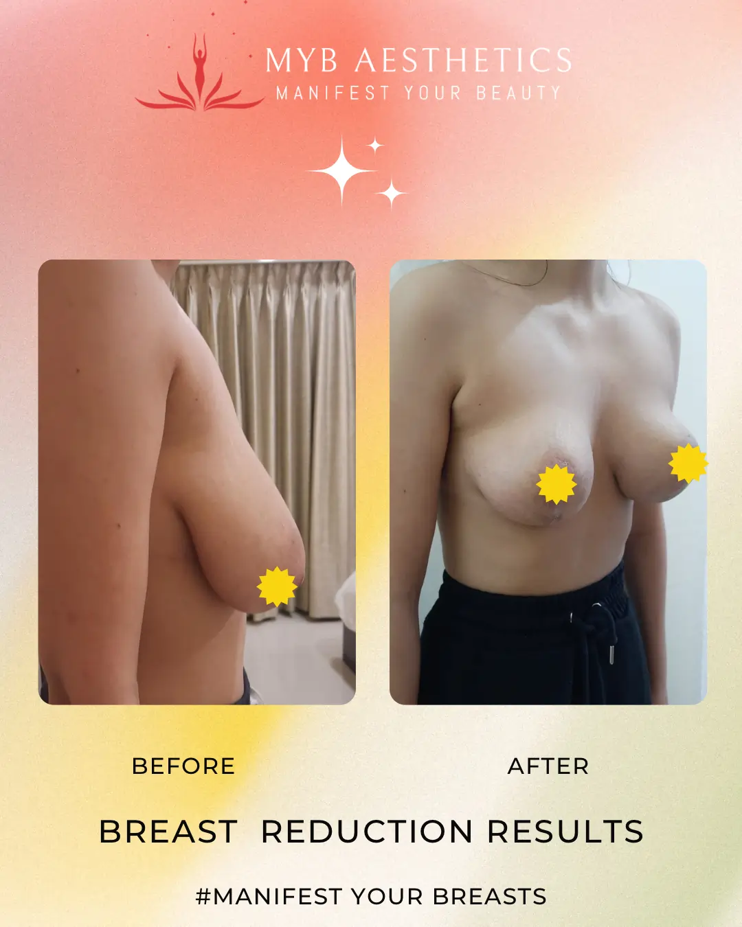 Before & After pics of Breast Reduction Surgery